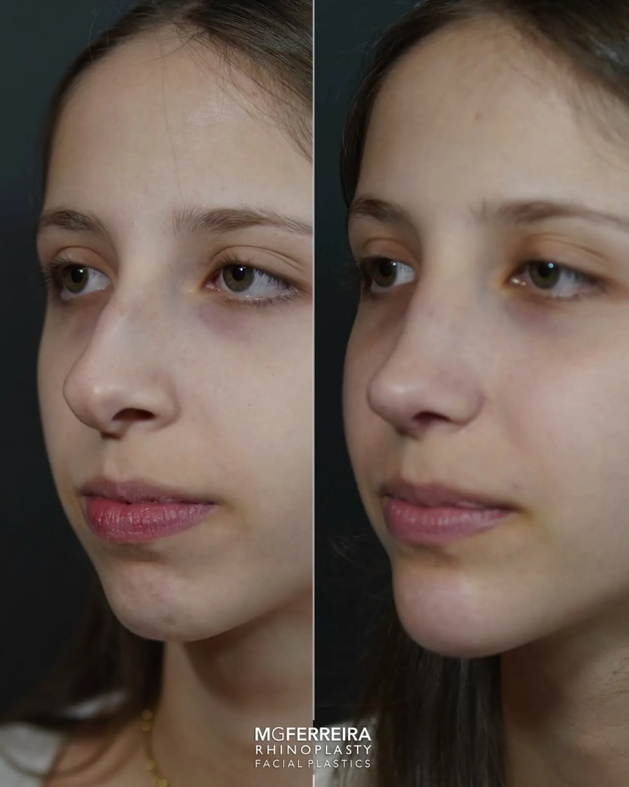Rinoplastia: giba acentuada num perfil com retrognatia, vista oblíqua oposta