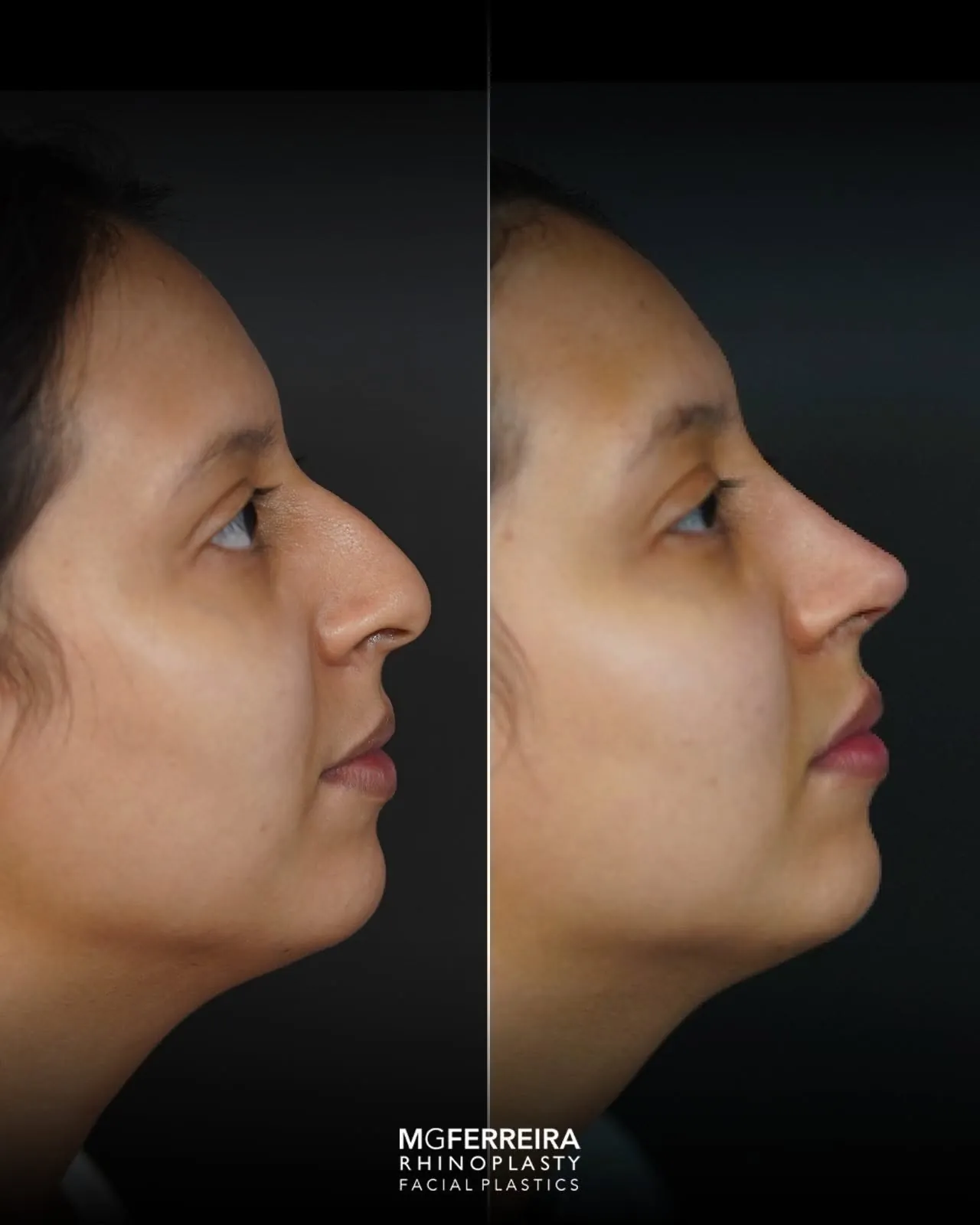 Rinoplastia: giba e ponta com pouco suporte, comparação de perfil