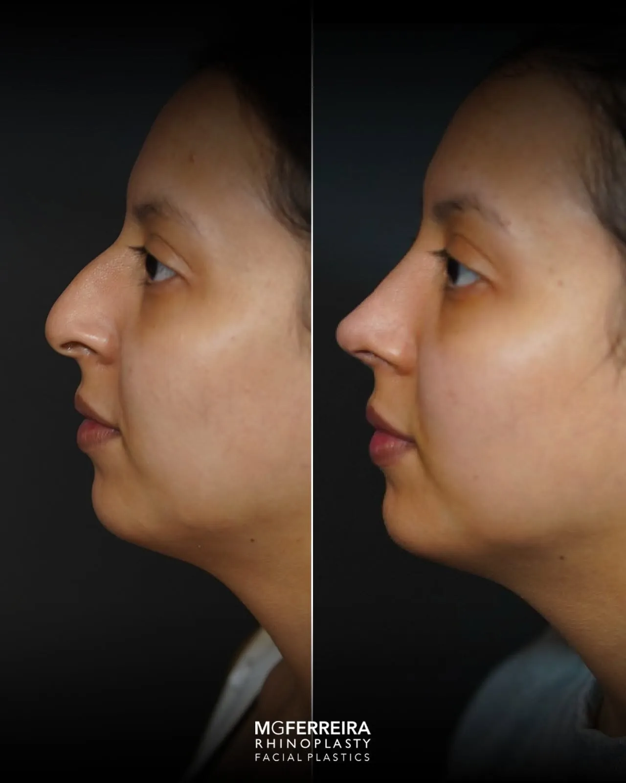 Rinoplastia: giba e ponta com pouco suporte, comparação de perfil oposto