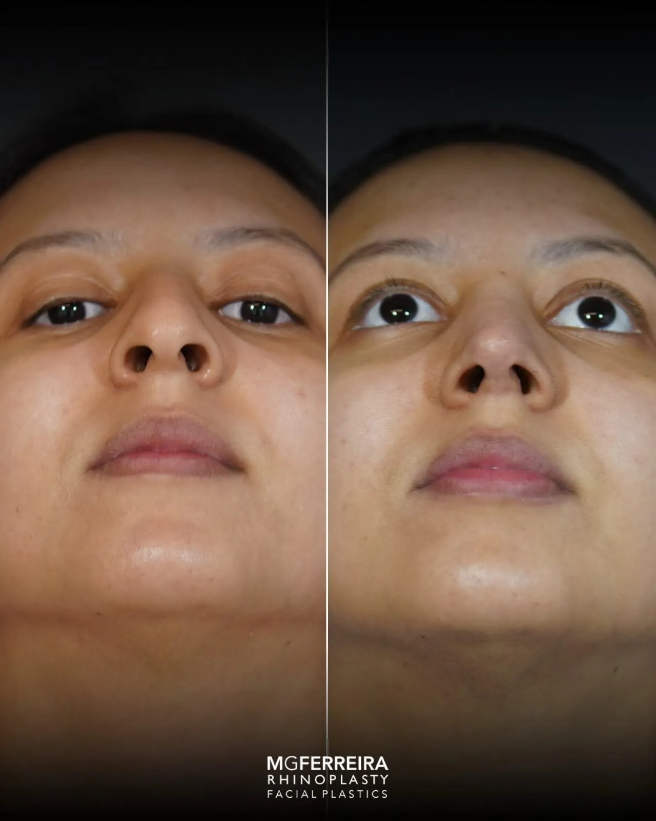 Rinoplastia: giba e ponta com pouco suporte, comparação em vista inferior