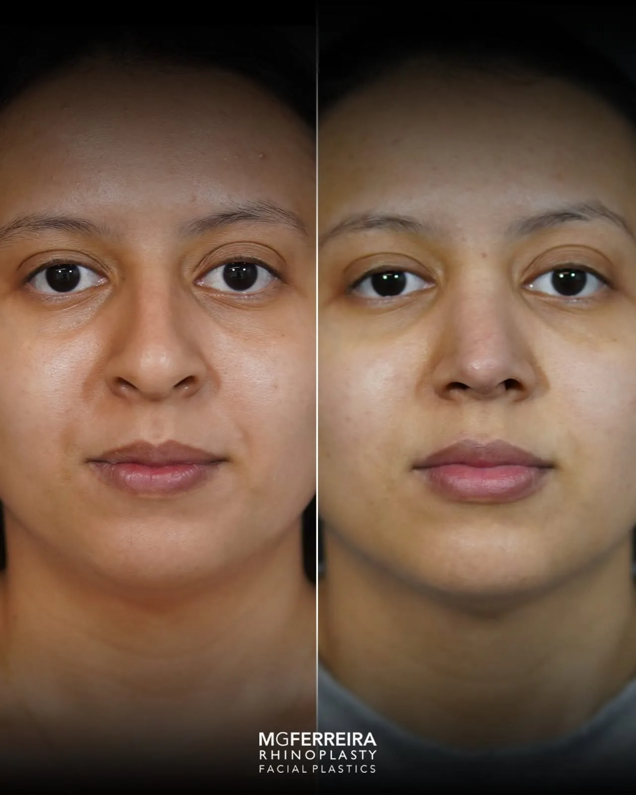 Rinoplastia: giba e ponta com pouco suporte, comparação frontal