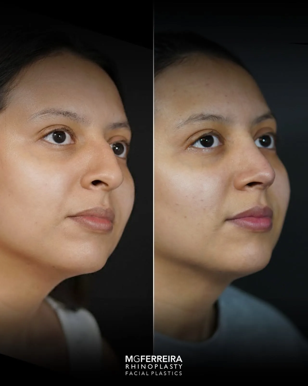 Rinoplastia: giba e ponta com pouco suporte, comparação oblíqua