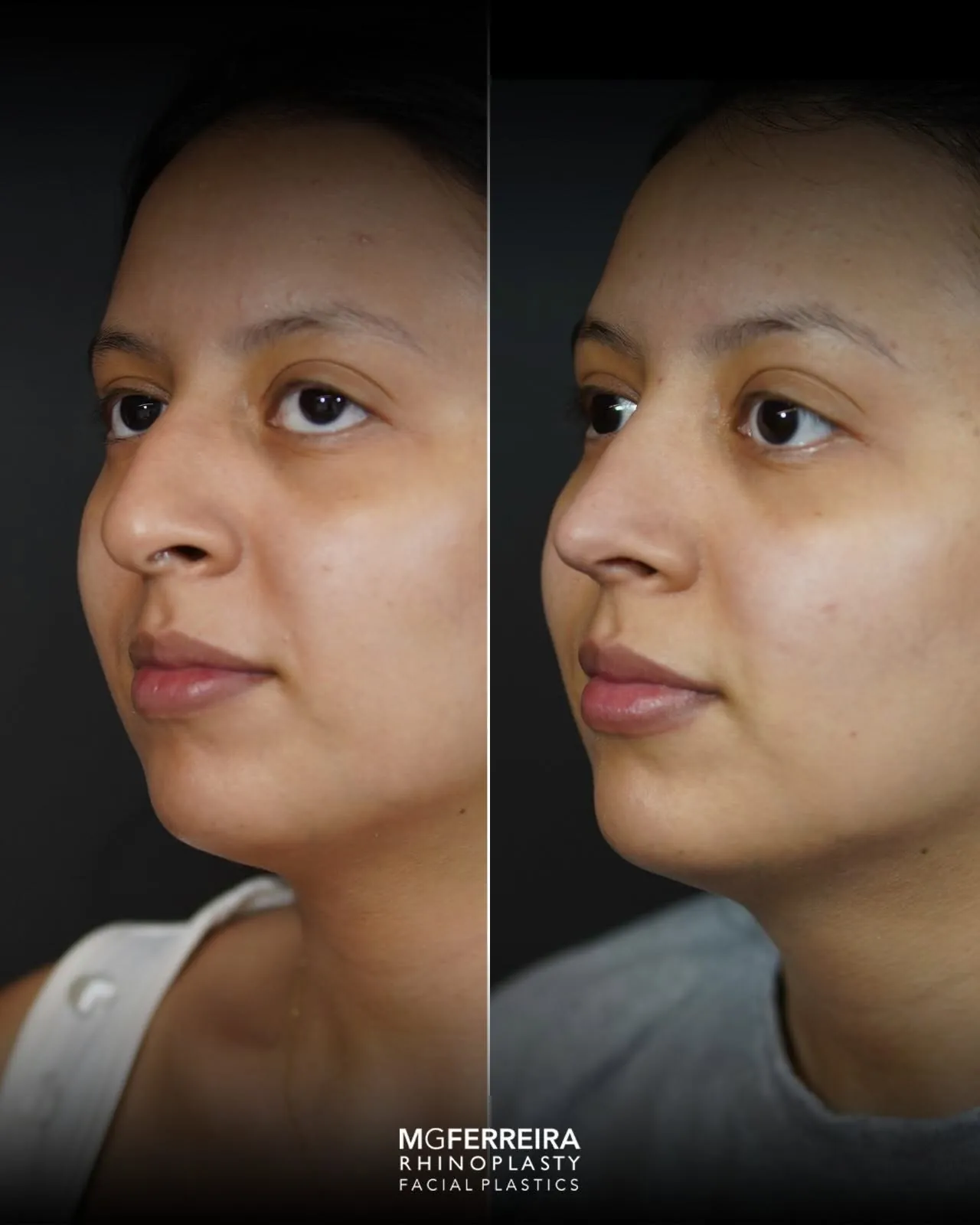 Rinoplastia: giba e ponta com pouco suporte, comparação oblíqua oposta