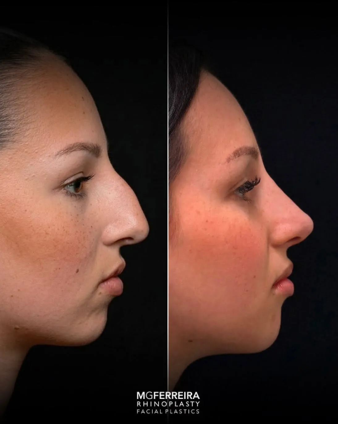 Comparação de perfil, Rinoplastia: giba nasal acentuada