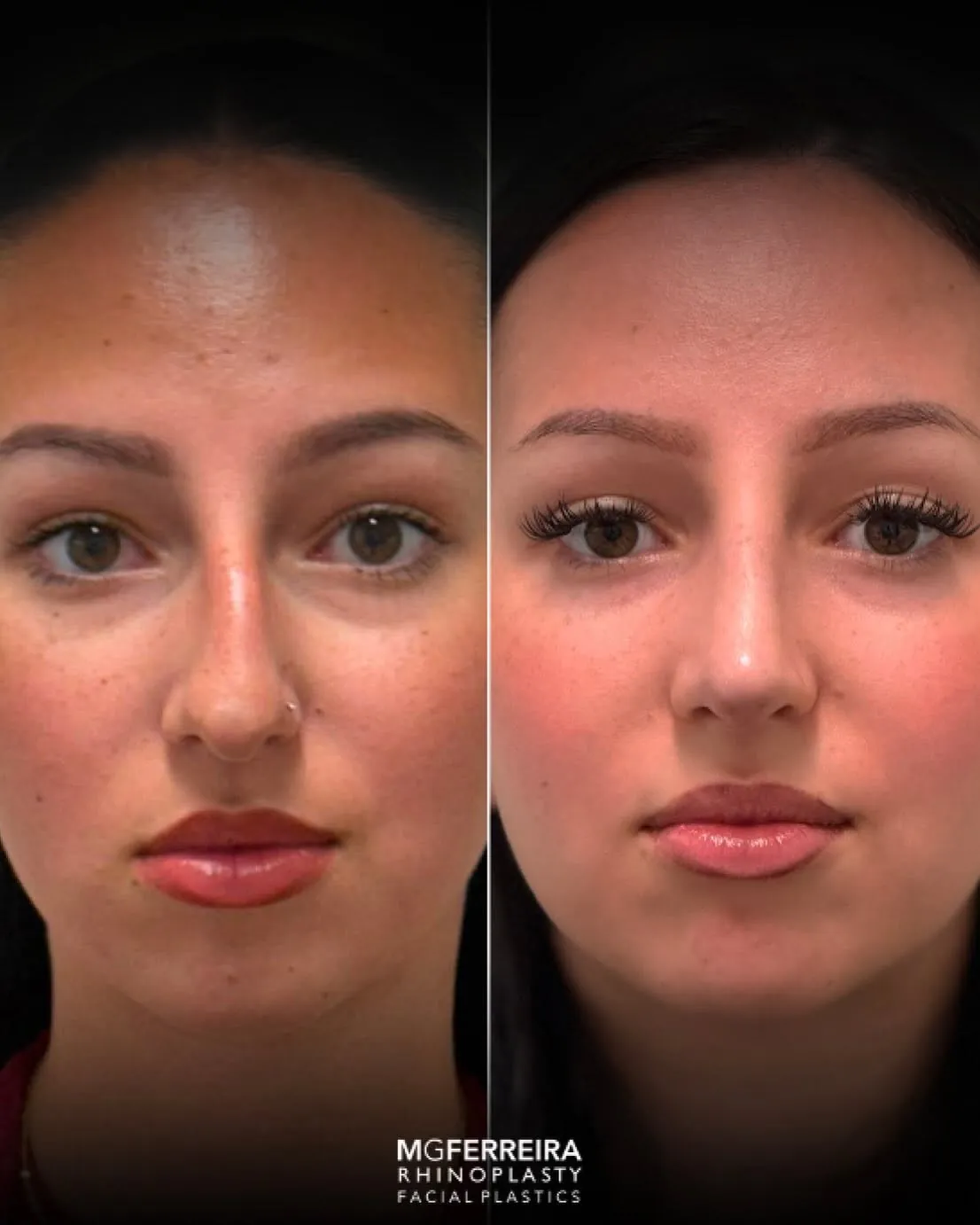 Comparação frontal, Rinoplastia: giba nasal acentuada