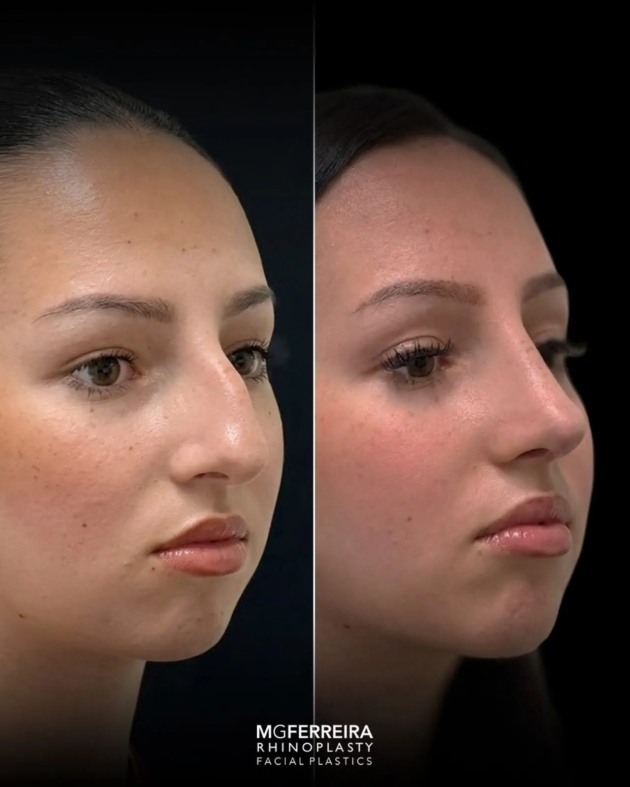 Comparação em vista oblíqua, Rinoplastia: giba nasal acentuada