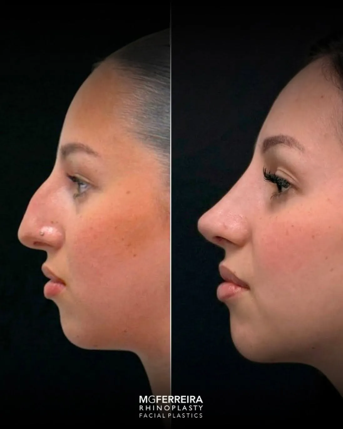 Comparação de perfil oposto, Rinoplastia: giba nasal acentuada