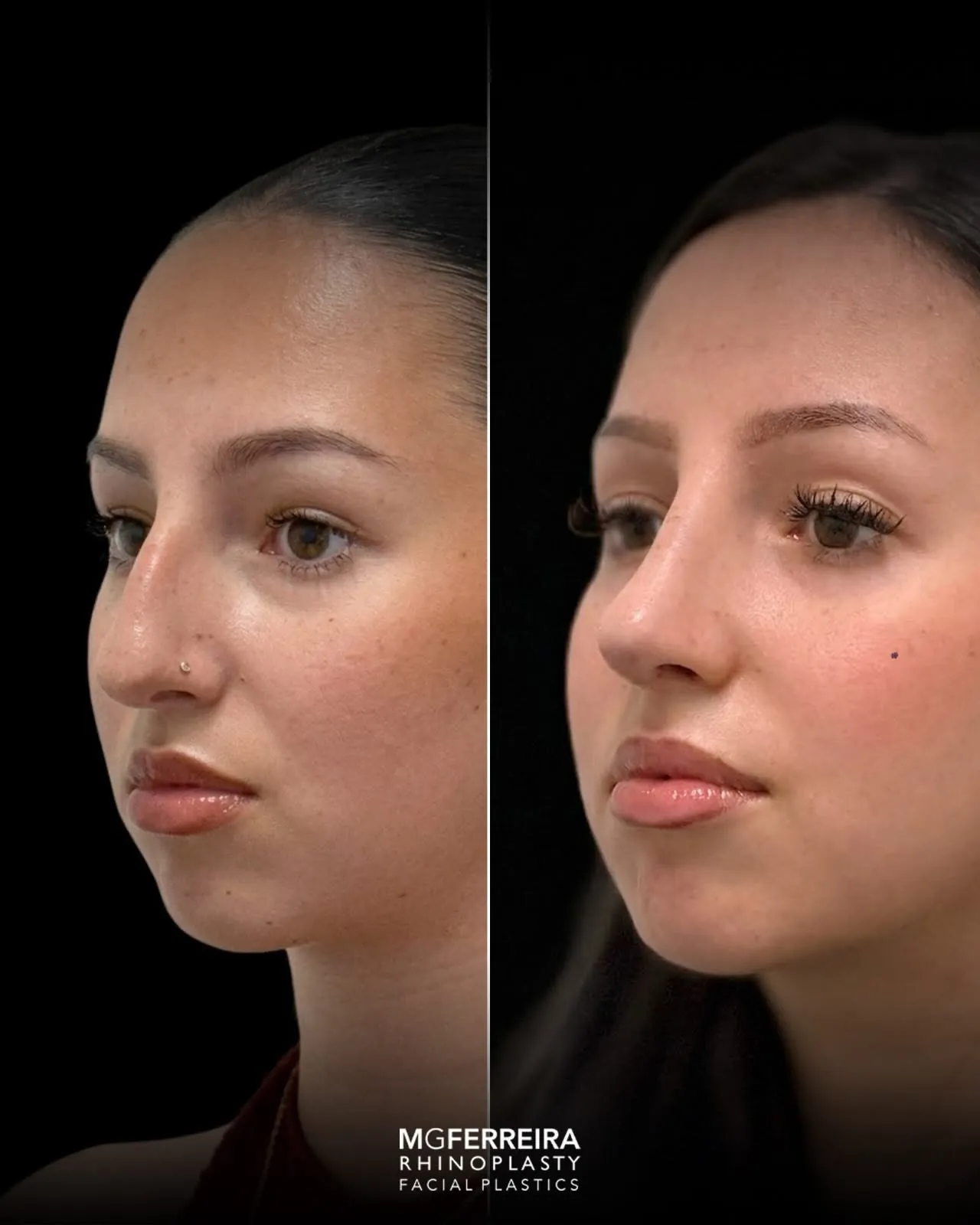 Comparação em vista oblíqua oposta, Rinoplastia: giba nasal acentuada