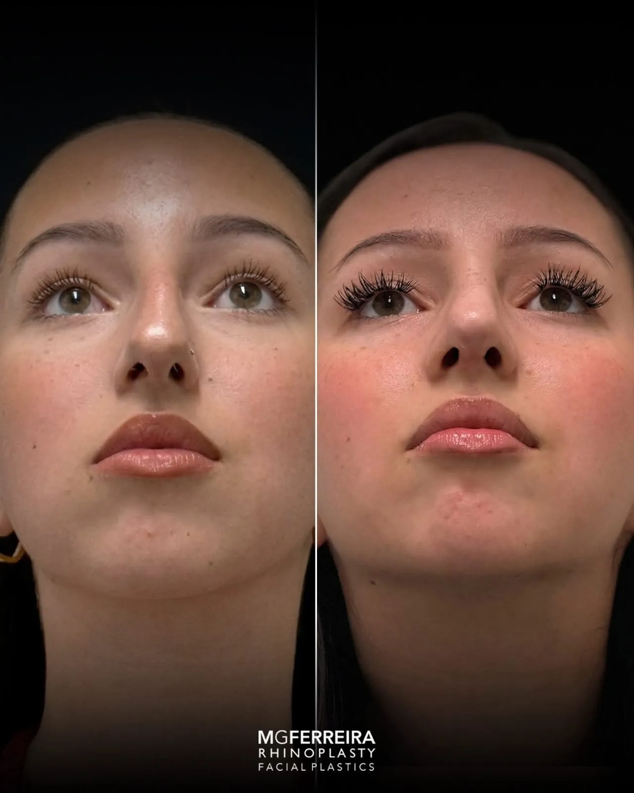 Comparação em vista inferior, Rinoplastia: giba nasal acentuada