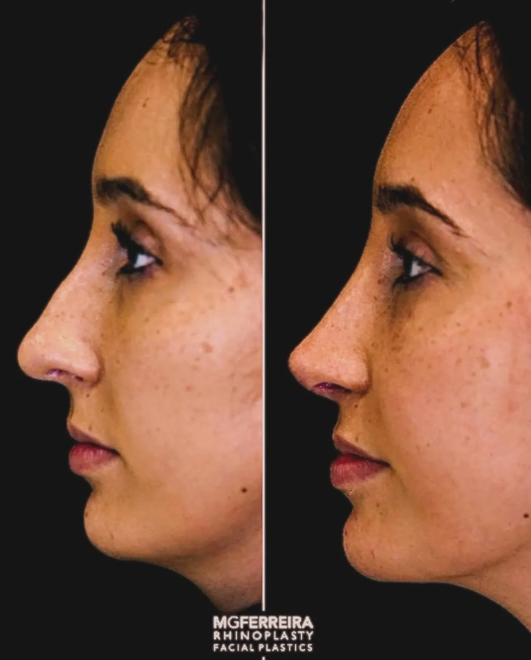 Comparação de perfil, Rinoplastia: giba, ponta caída e retração alar