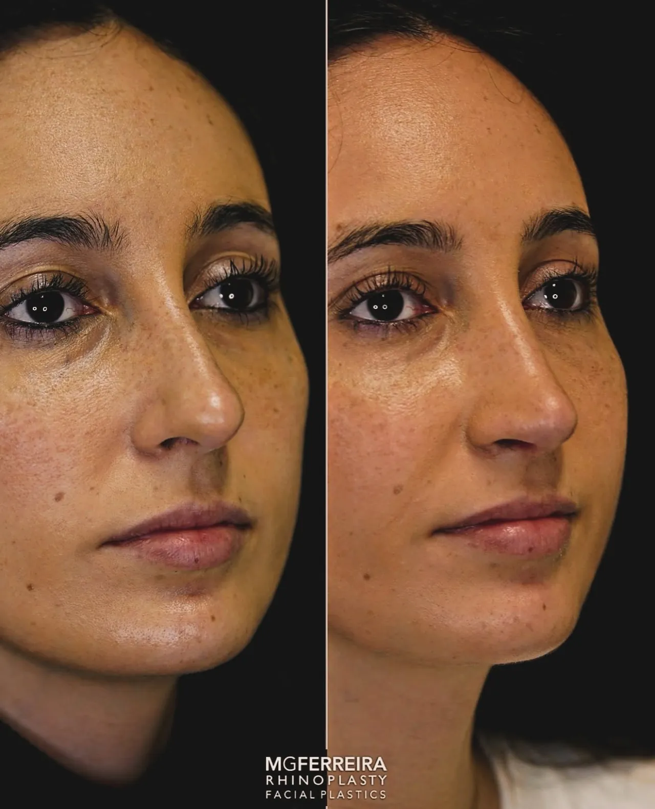 Comparação em vista oblíqua oposta, Rinoplastia: giba, ponta caída e retração alar