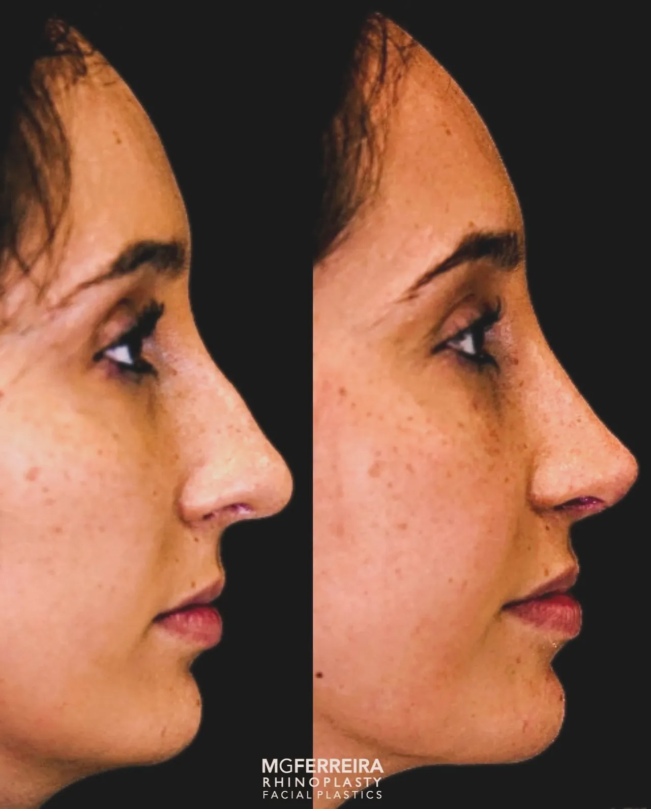 Comparação de perfil oposto, Rinoplastia: giba, ponta caída e retração alar