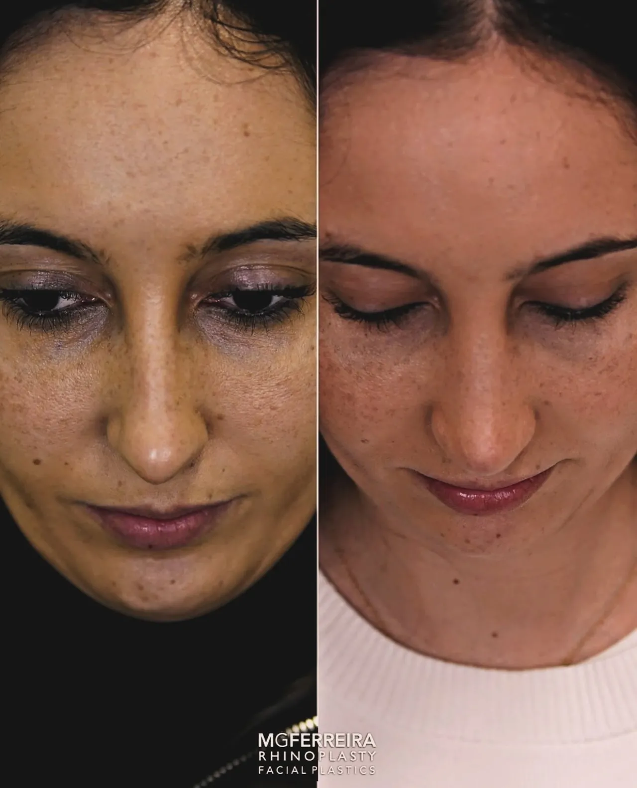 Comparação com a cabeça inclinada, Rinoplastia: giba, ponta caída e retração alar