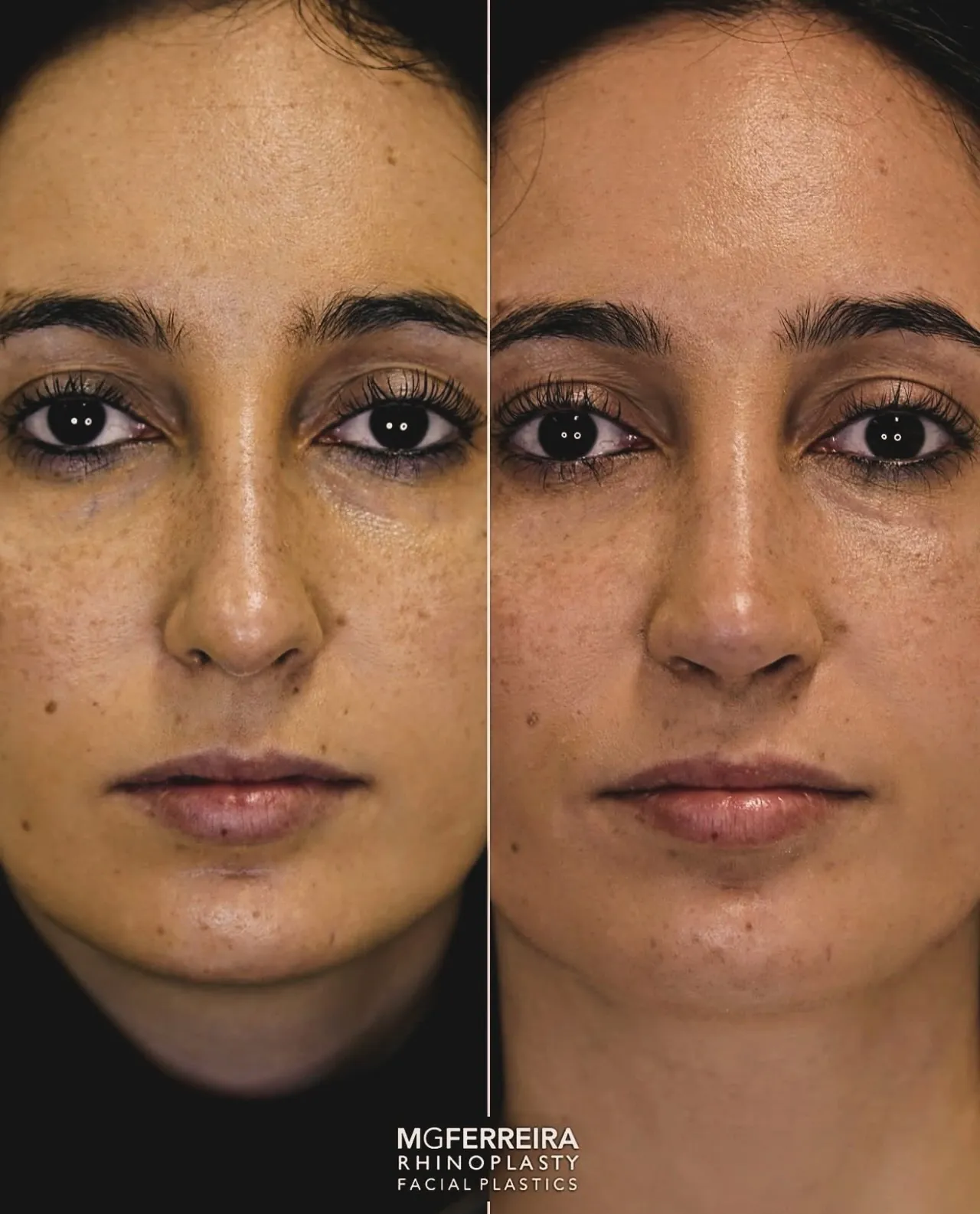 Comparação frontal, Rinoplastia: giba, ponta caída e retração alar