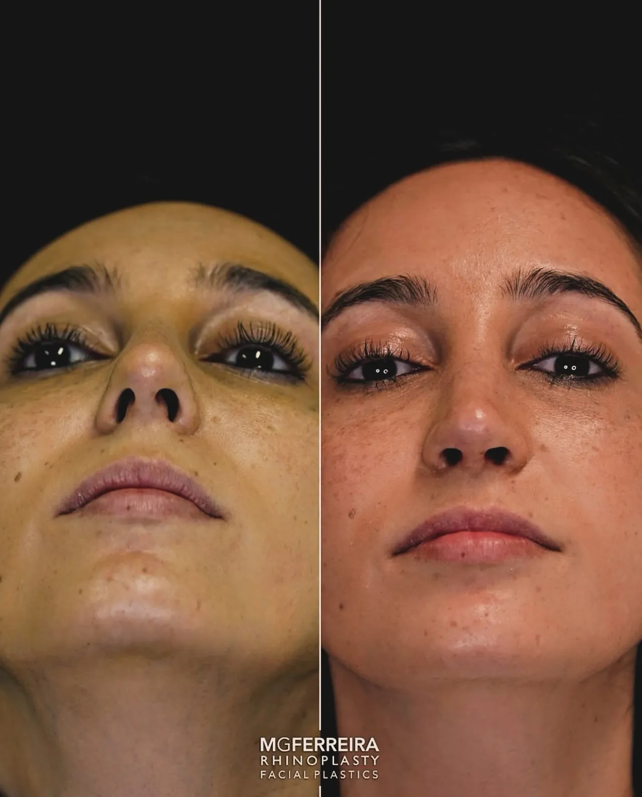Comparação em vista inferior, Rinoplastia: giba, ponta caída e retração alar