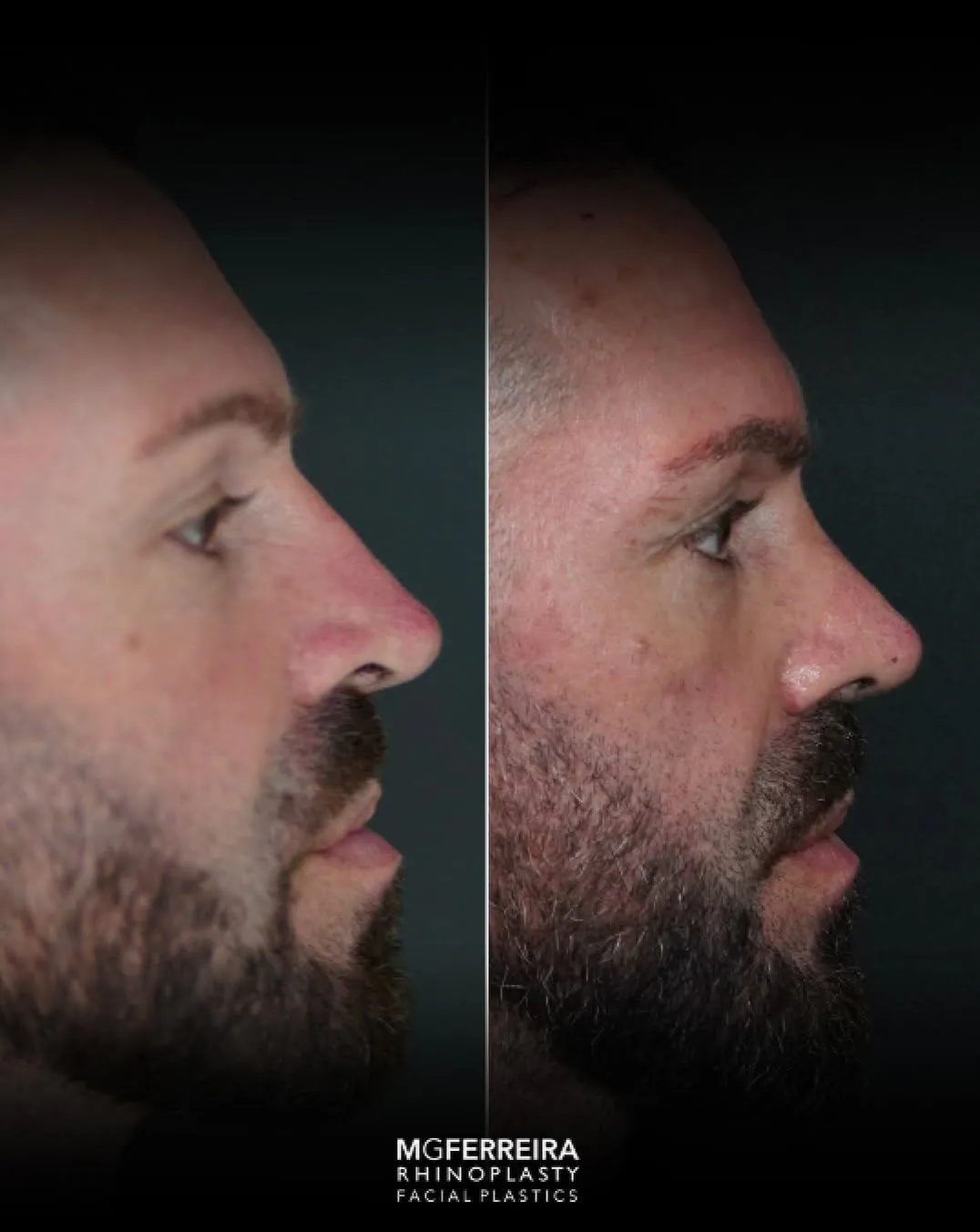 Rinoplastia masculina de revisão: ponta e relação alar-columelar, perfil