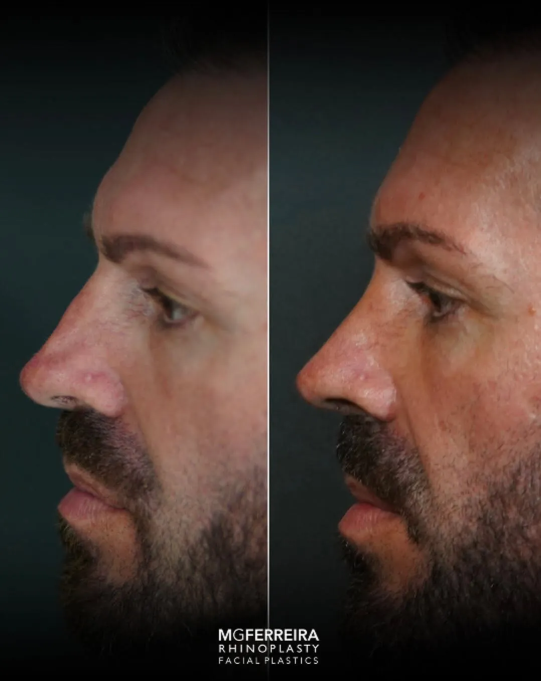 Rinoplastia masculina de revisão: ponta e relação alar-columelar, perfil oposto
