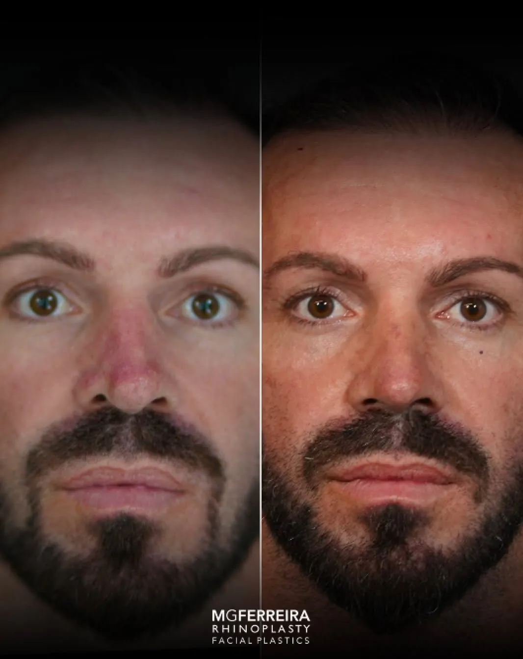 Rinoplastia masculina de revisão: ponta e relação alar-columelar, vista frontal
