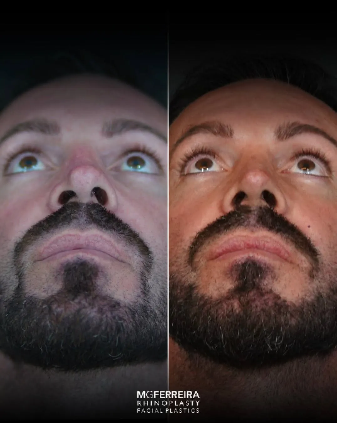 Rinoplastia masculina de revisão: ponta e relação alar-columelar, vista inferior