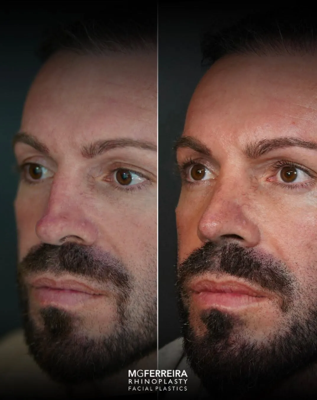 Rinoplastia masculina de revisão: ponta e relação alar-columelar, vista oblíqua