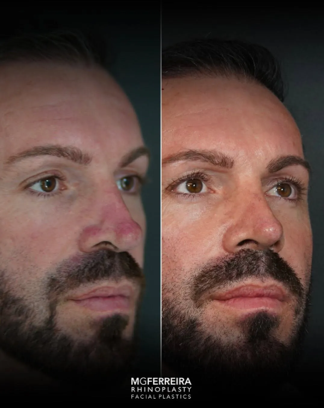 Rinoplastia masculina de revisão: ponta e relação alar-columelar, vista oblíqua oposta
