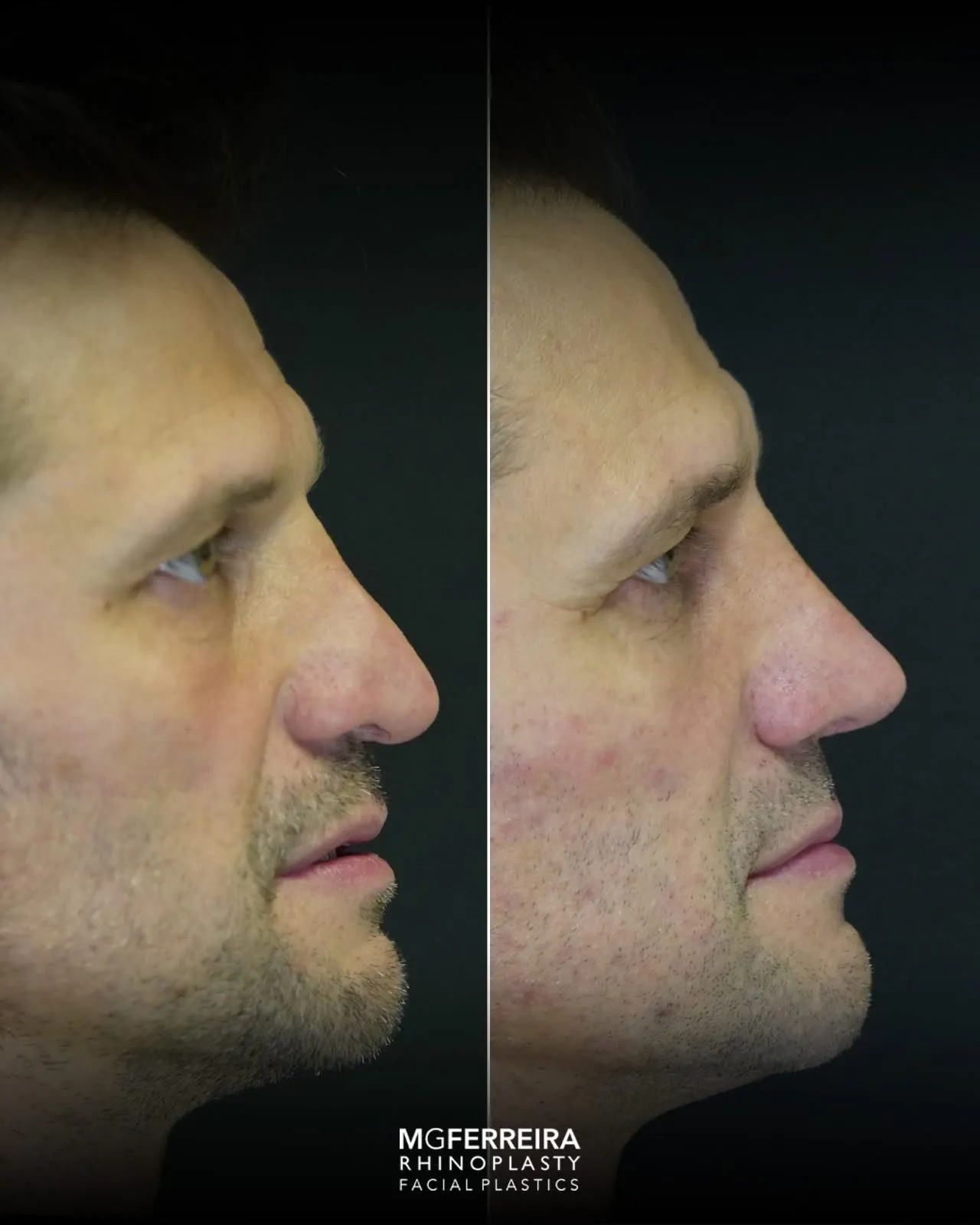 Rinoplastia masculina de revisão, comparação de perfil direito