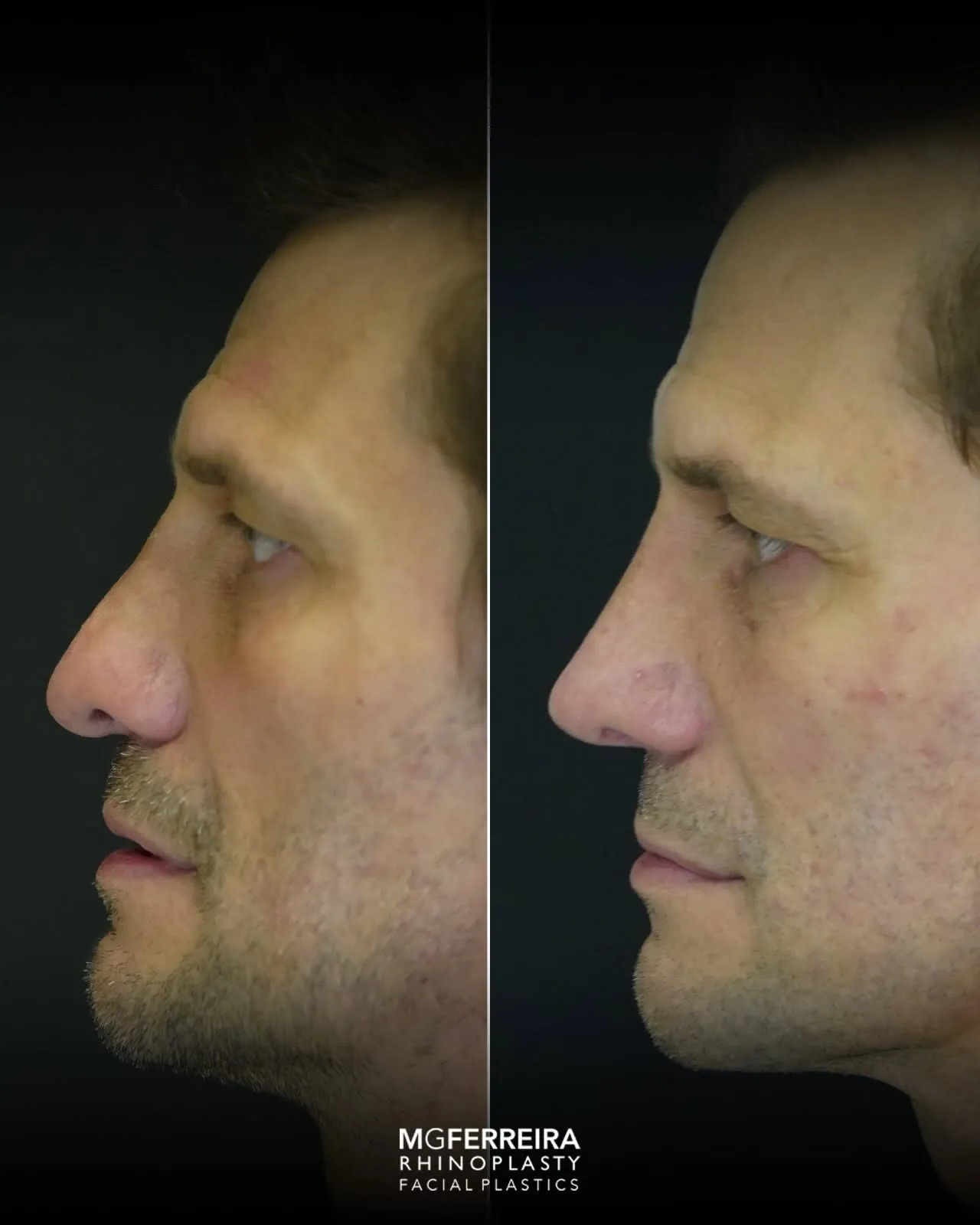 Rinoplastia masculina de revisão, comparação de perfil esquerdo
