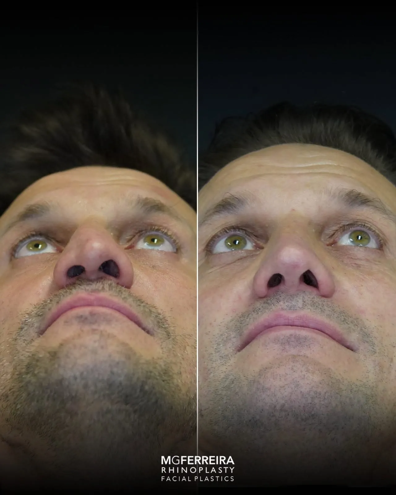 Rinoplastia masculina de revisão, comparação em vista inferior