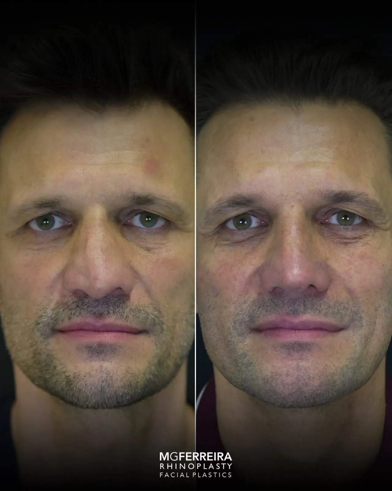 Rinoplastia masculina de revisão, comparação frontal
