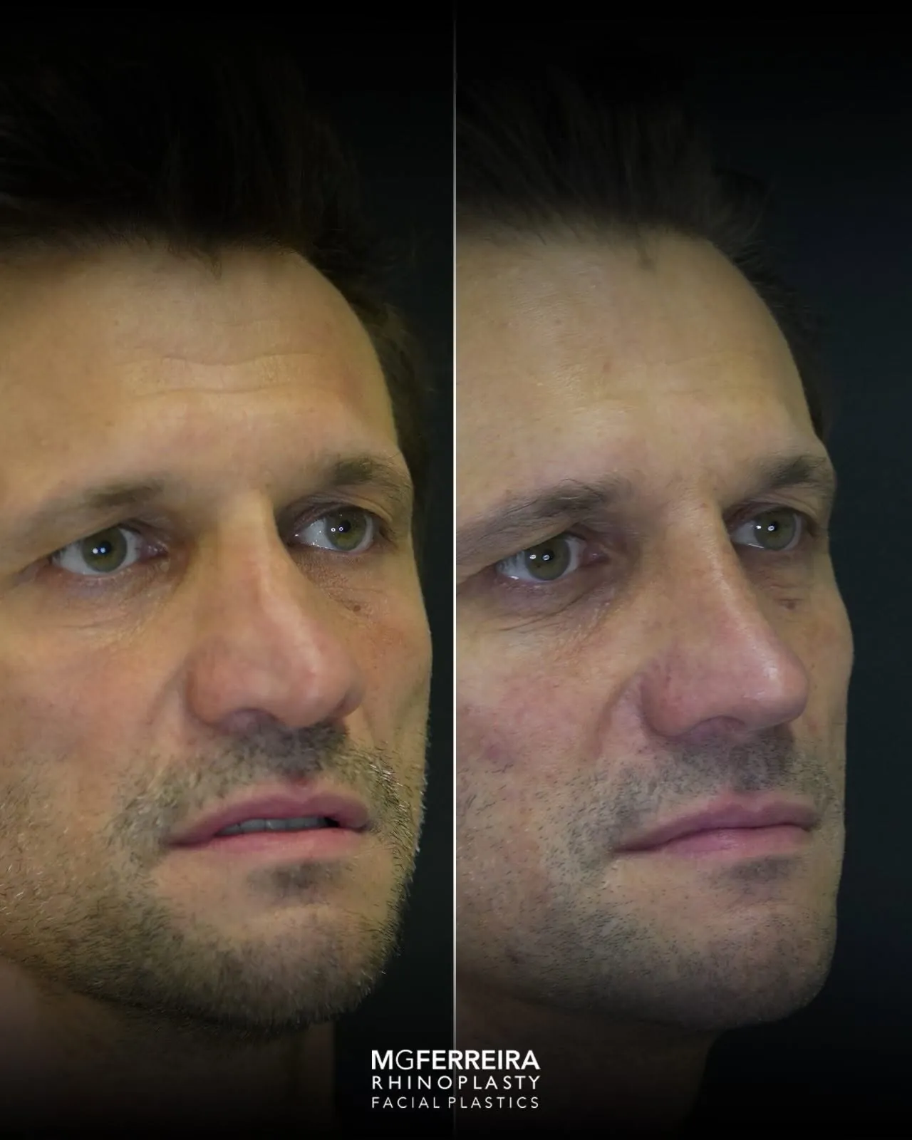 Rinoplastia masculina de revisão, comparação oblíqua direita