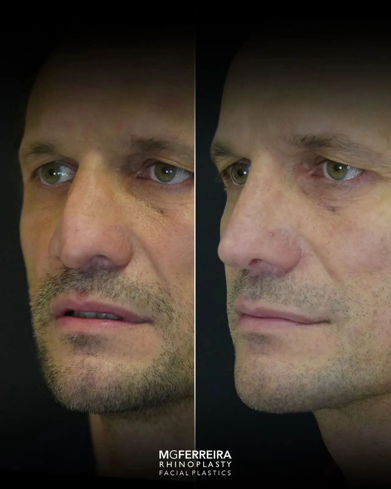Rinoplastia masculina de revisão, comparação oblíqua esquerda