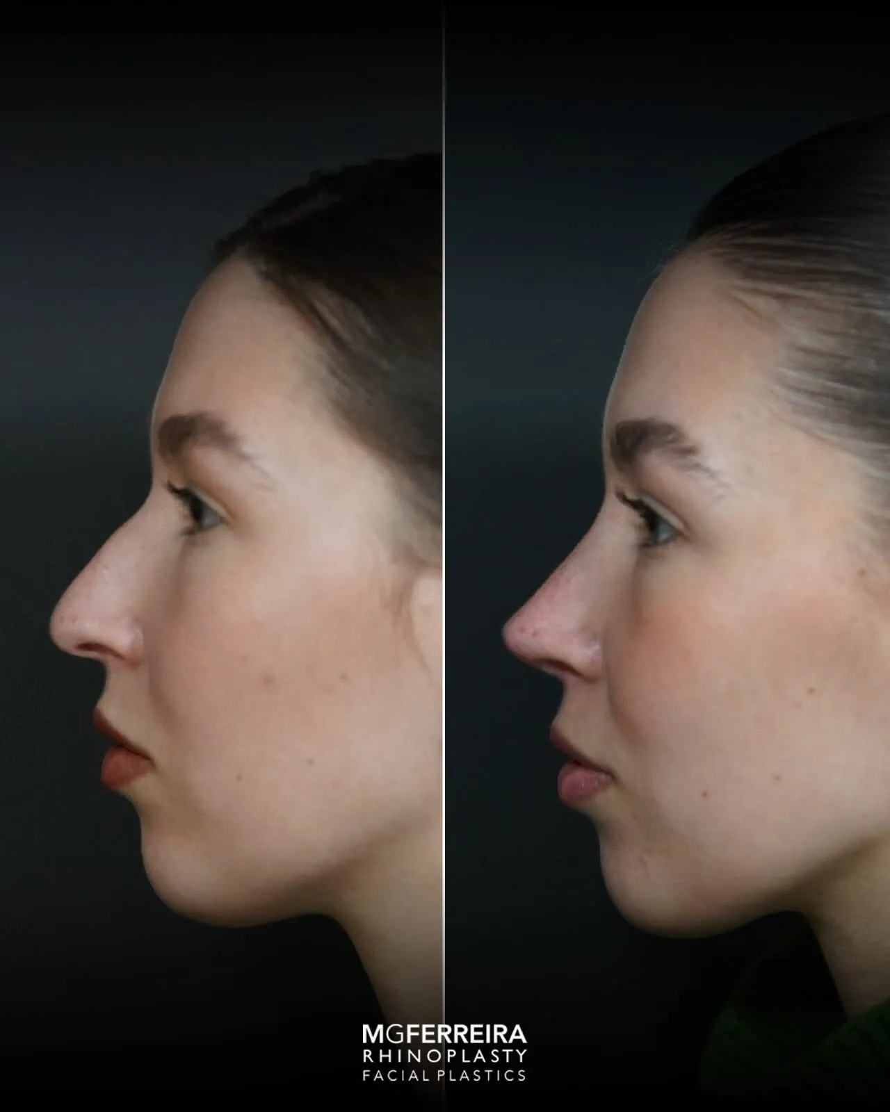 Rinoplastia: nariz desviado e giba dorsal, perfil