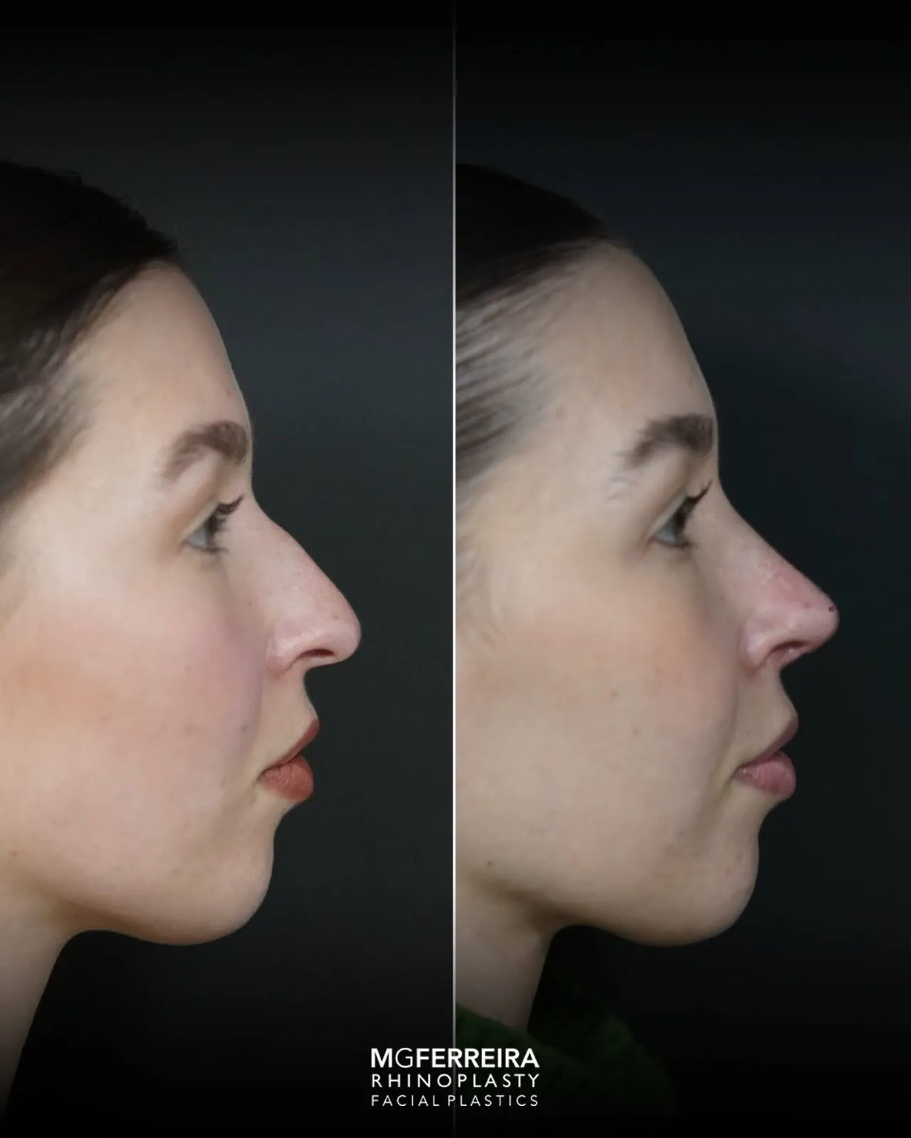 Rinoplastia: nariz desviado e giba dorsal, perfil oposto