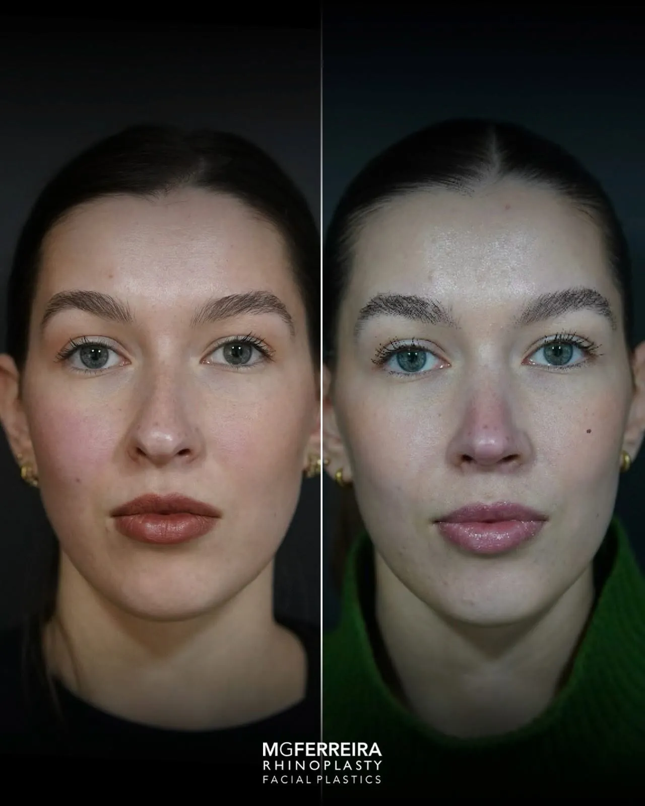 Rinoplastia: nariz desviado e giba dorsal, vista frontal