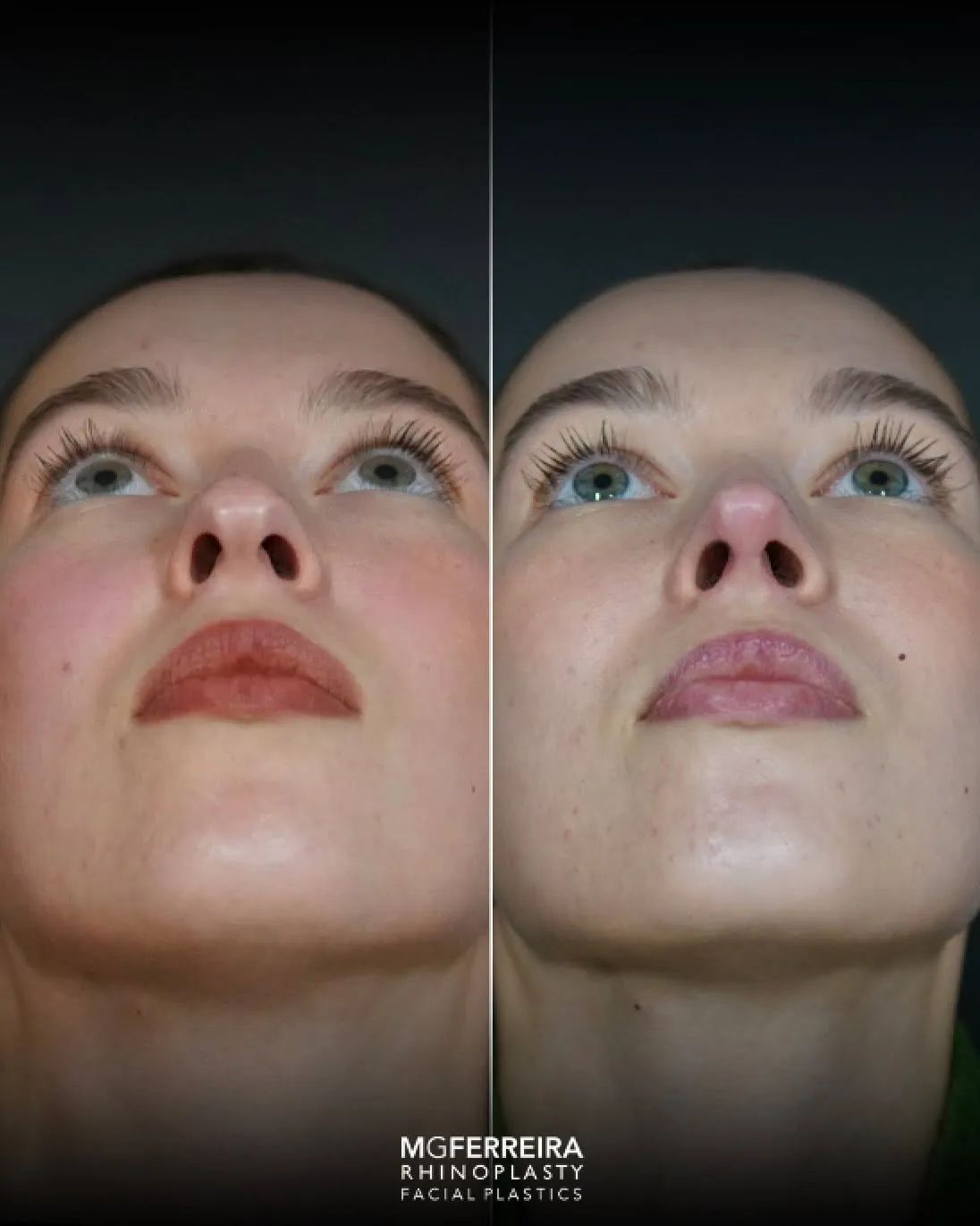 Rinoplastia: nariz desviado e giba dorsal, vista inferior