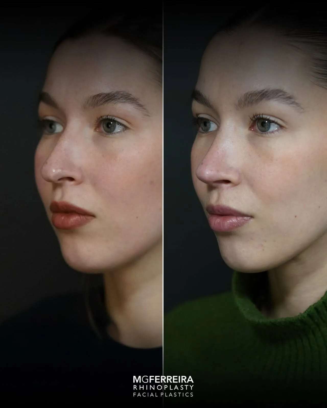 Rinoplastia: nariz desviado e giba dorsal, vista oblíqua