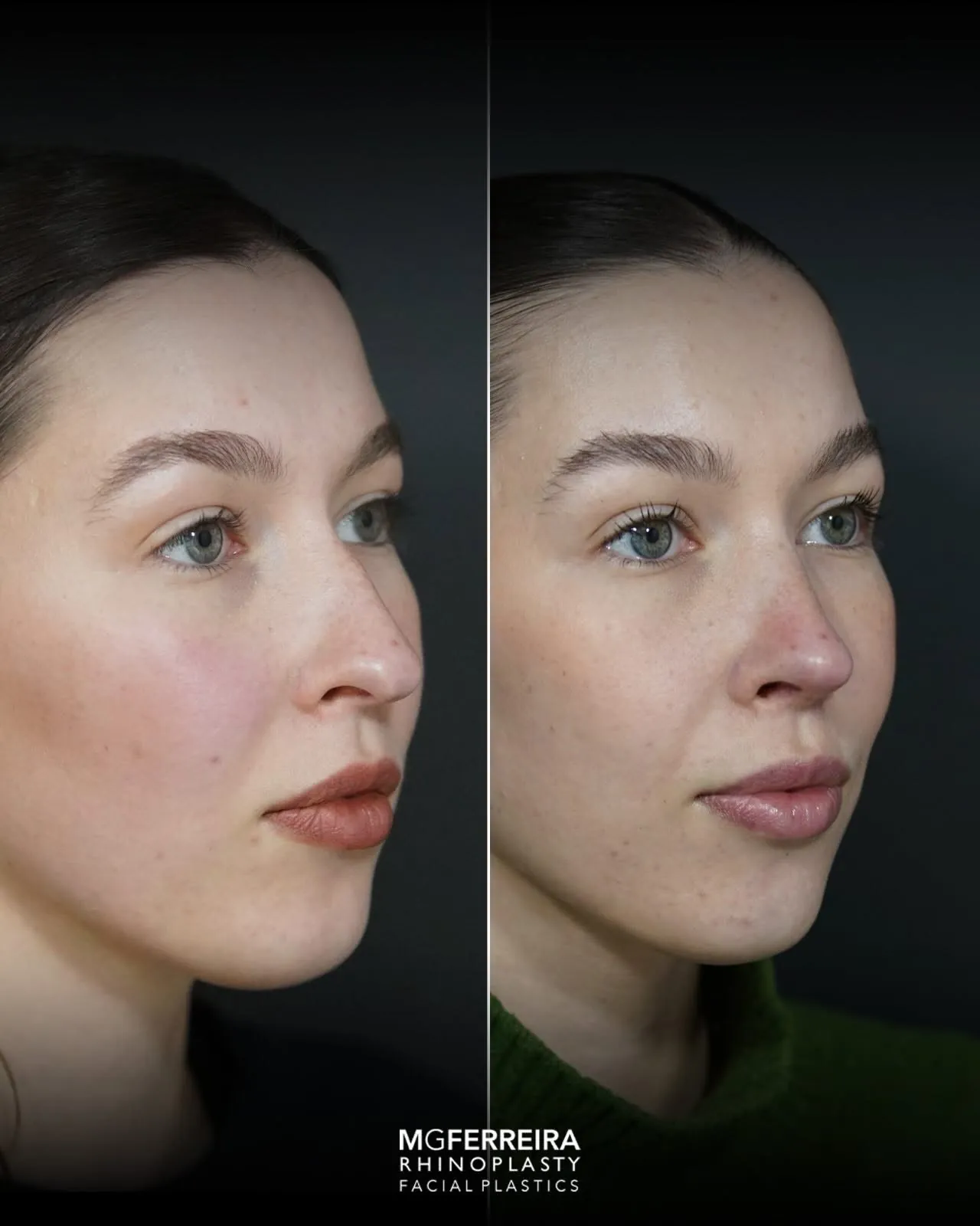 Rinoplastia: nariz desviado e giba dorsal, vista oblíqua oposta
