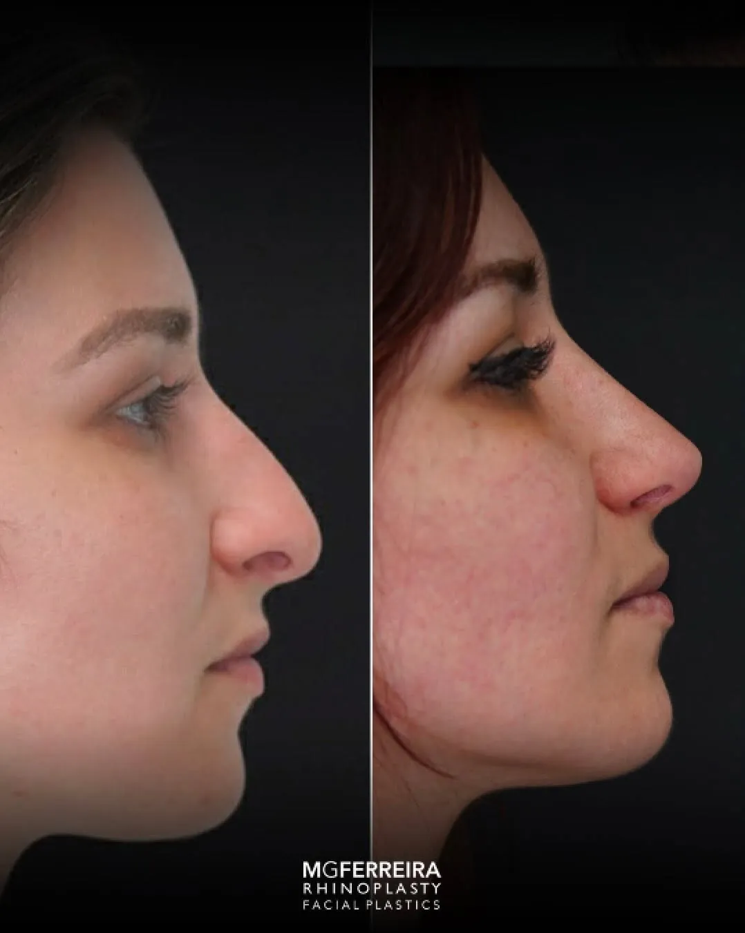 Rinoplastia: ponta caída e nariz arciforme, perfil