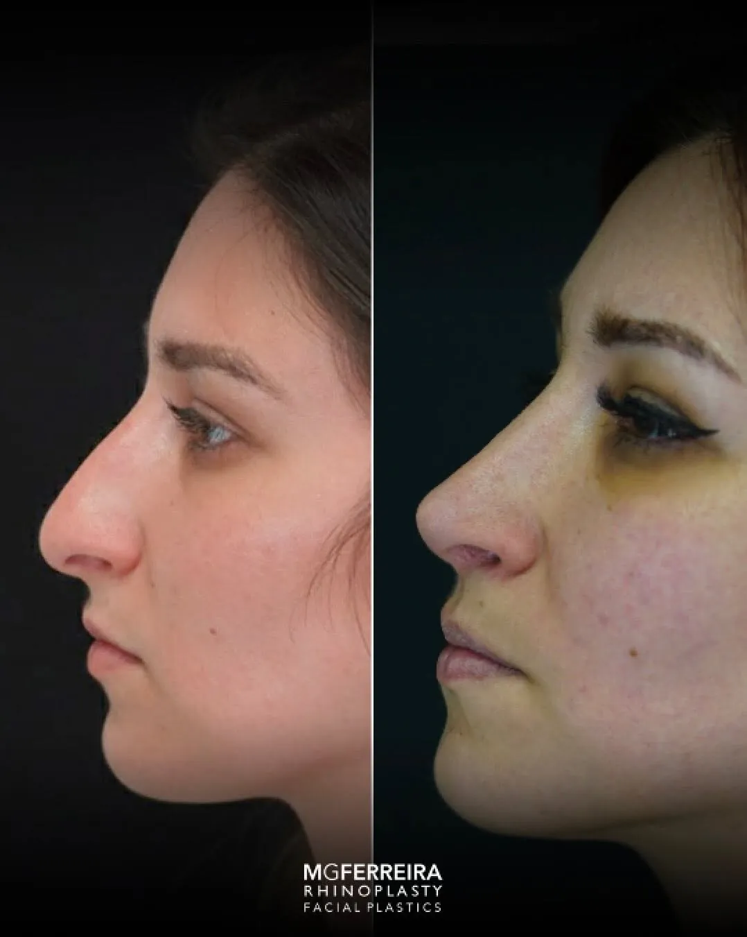 Rinoplastia: ponta caída e nariz arciforme, perfil oposto