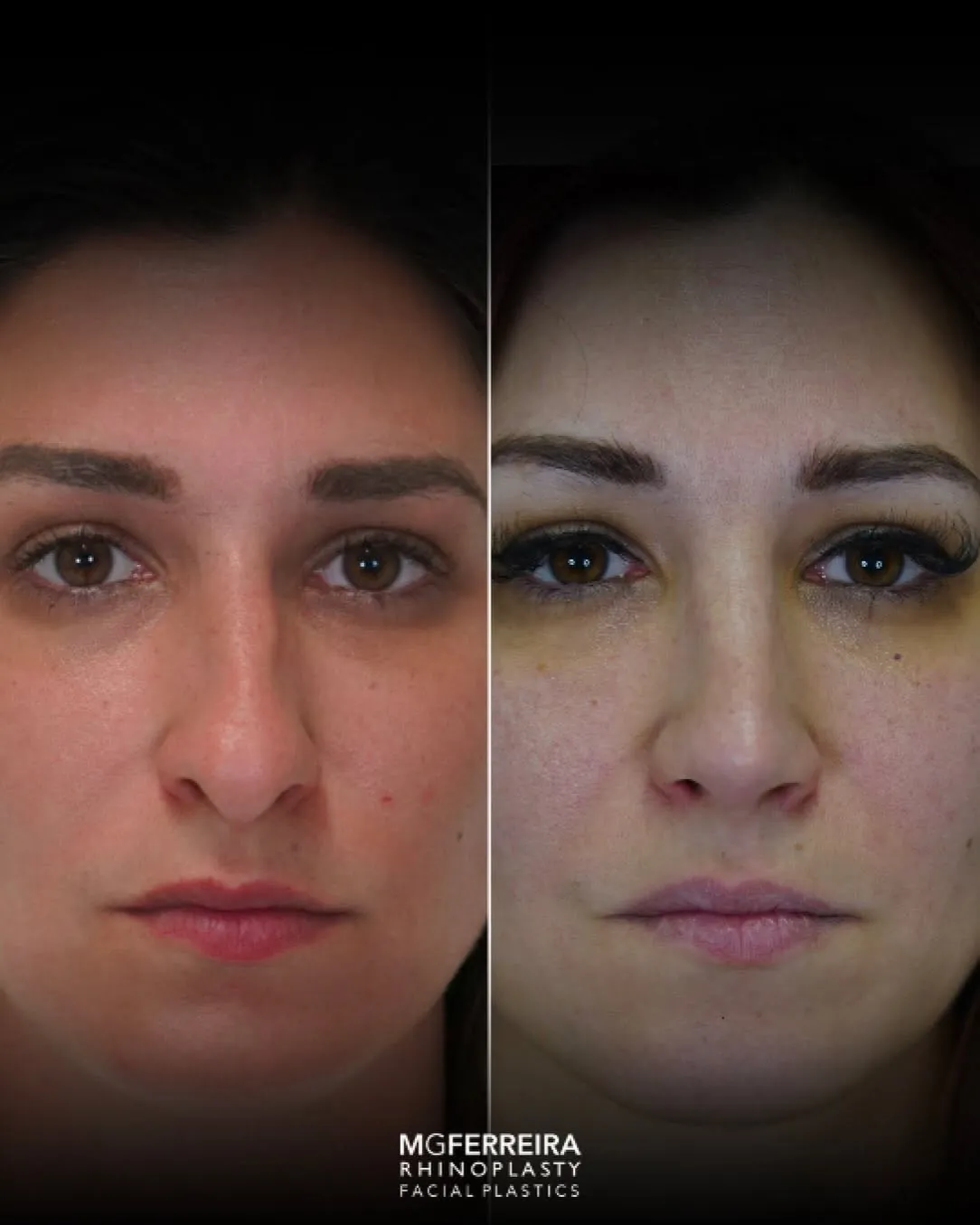Rinoplastia: ponta caída e nariz arciforme, vista frontal