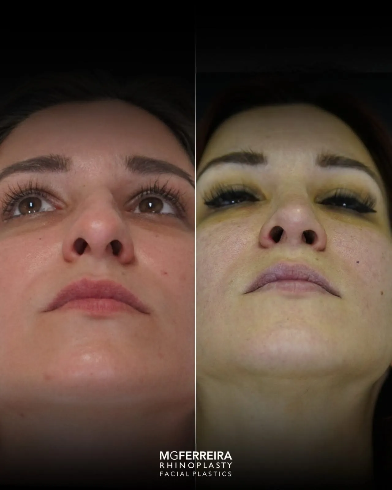 Rinoplastia: ponta caída e nariz arciforme, vista inferior