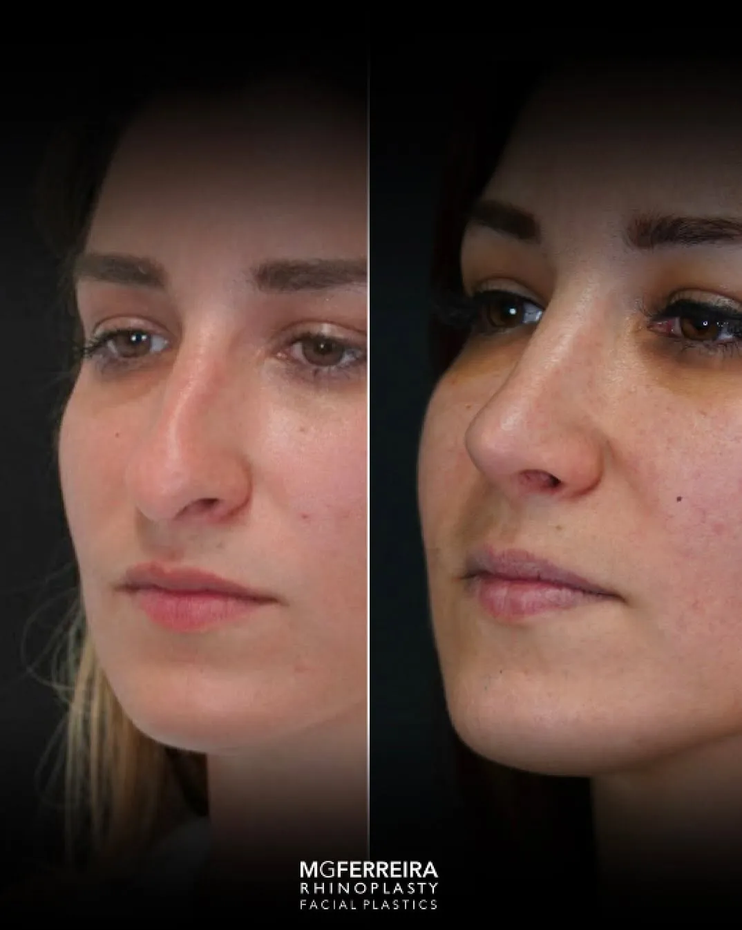 Rinoplastia: ponta caída e nariz arciforme, vista oblíqua