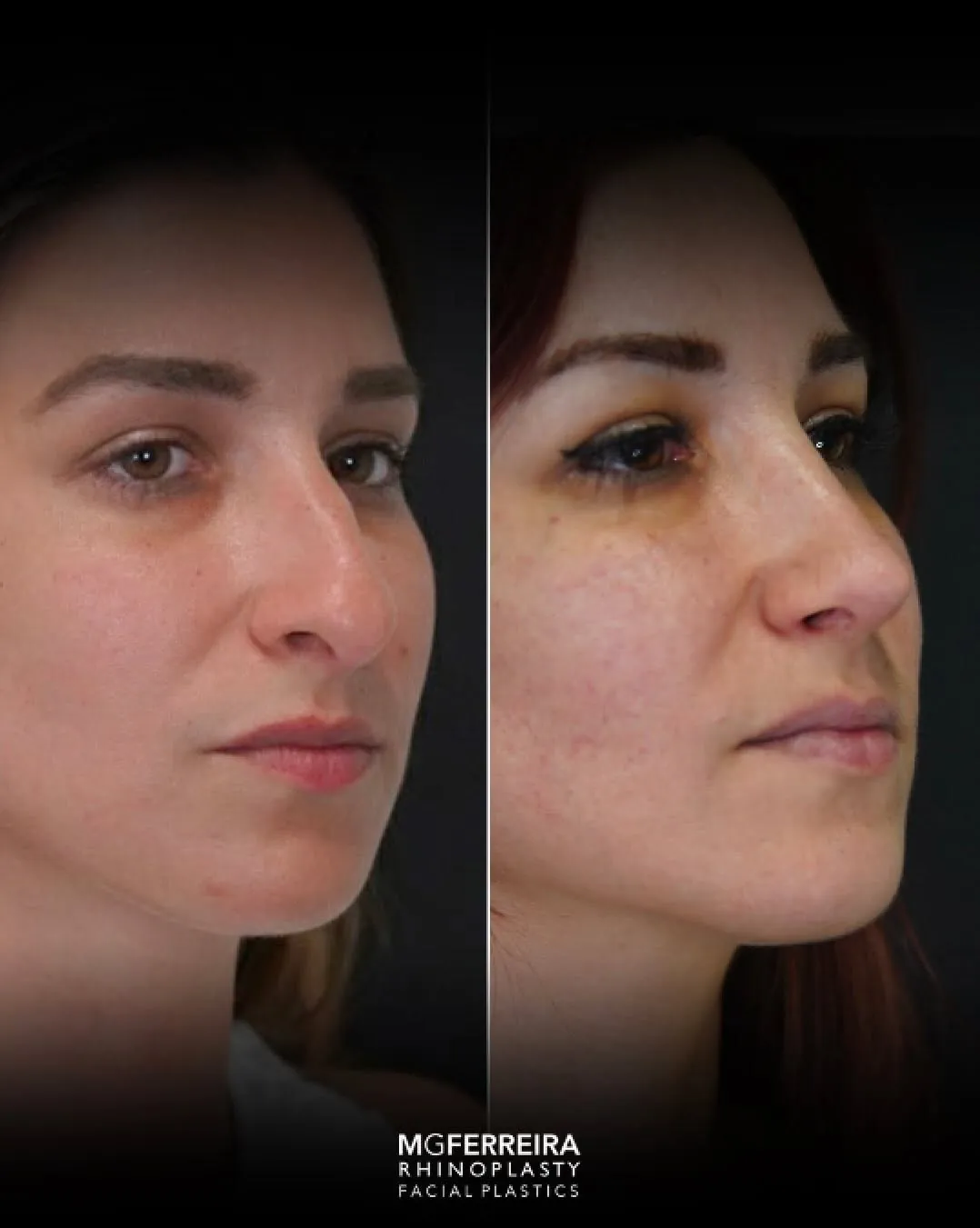 Rinoplastia: ponta caída e nariz arciforme, vista oblíqua oposta