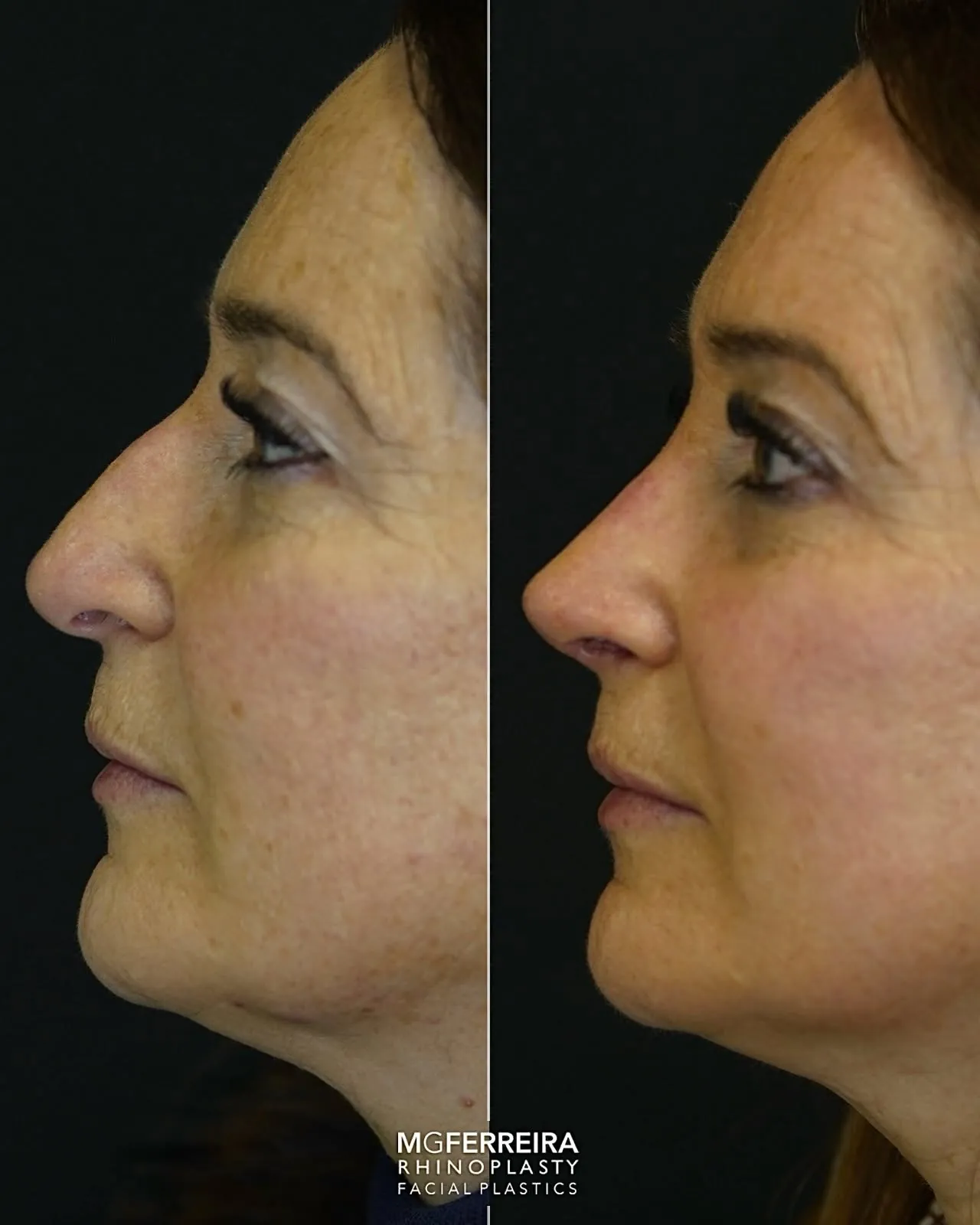 Comparação de perfil, Rinoplastia: ponta caída e retração alar
