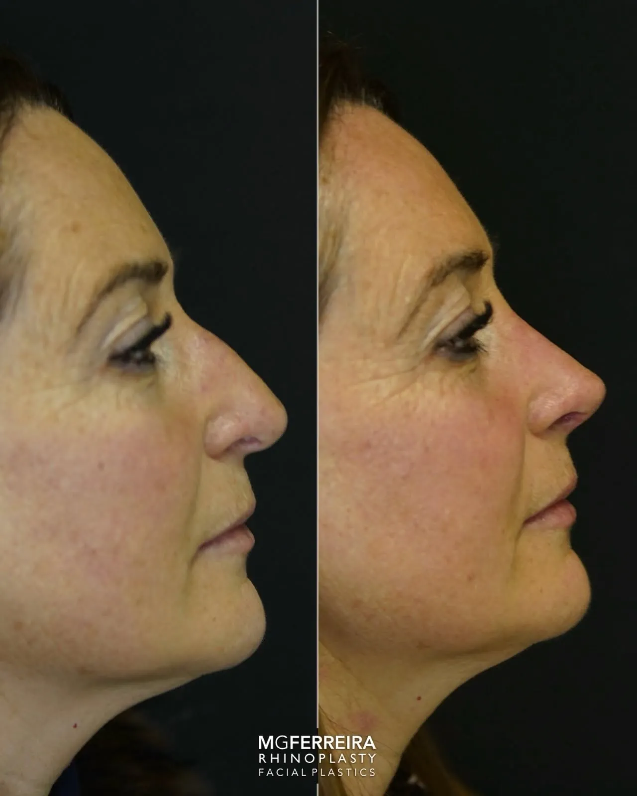 Comparação de perfil oposto, Rinoplastia: ponta caída e retração alar