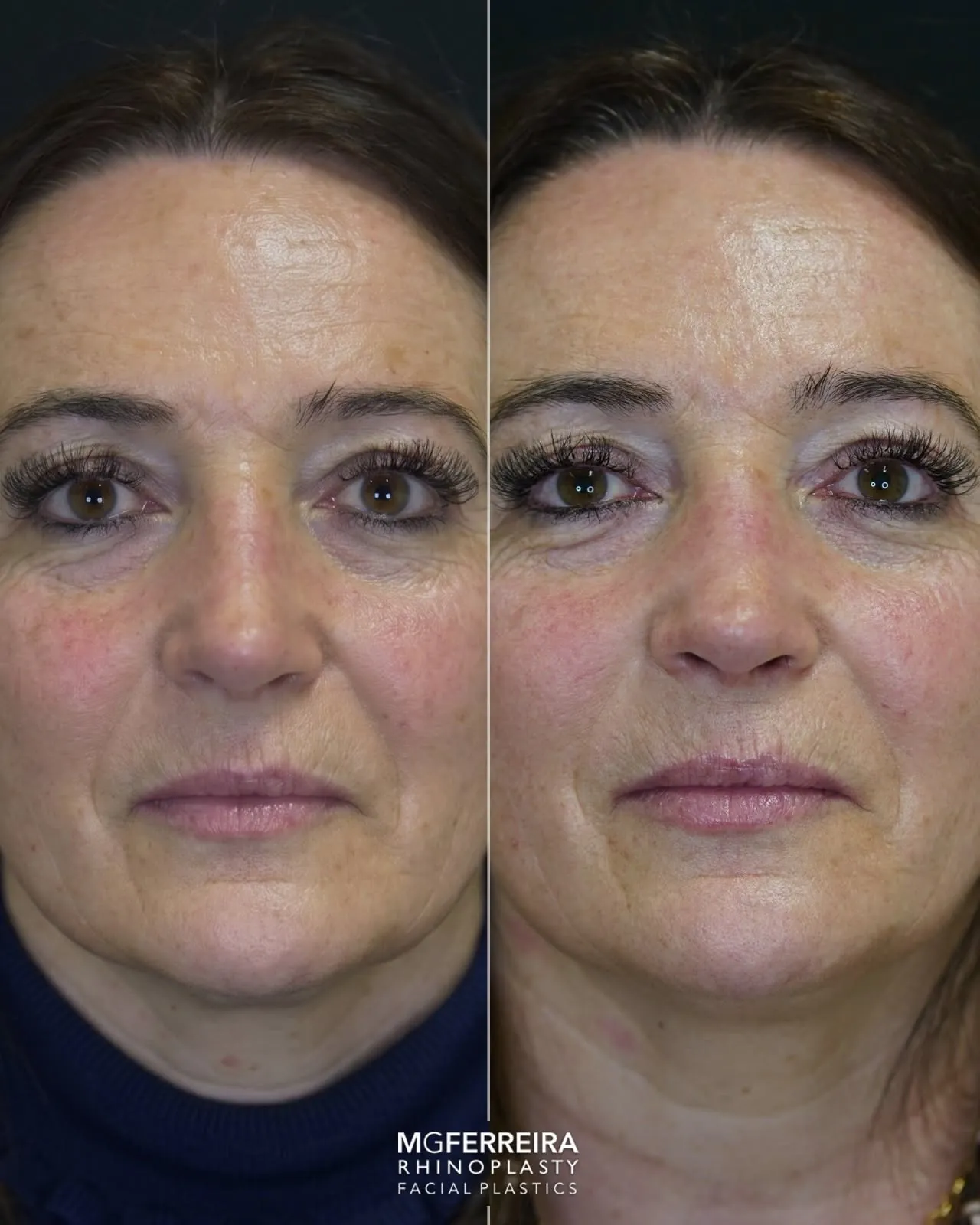Comparação frontal, Rinoplastia: ponta caída e retração alar