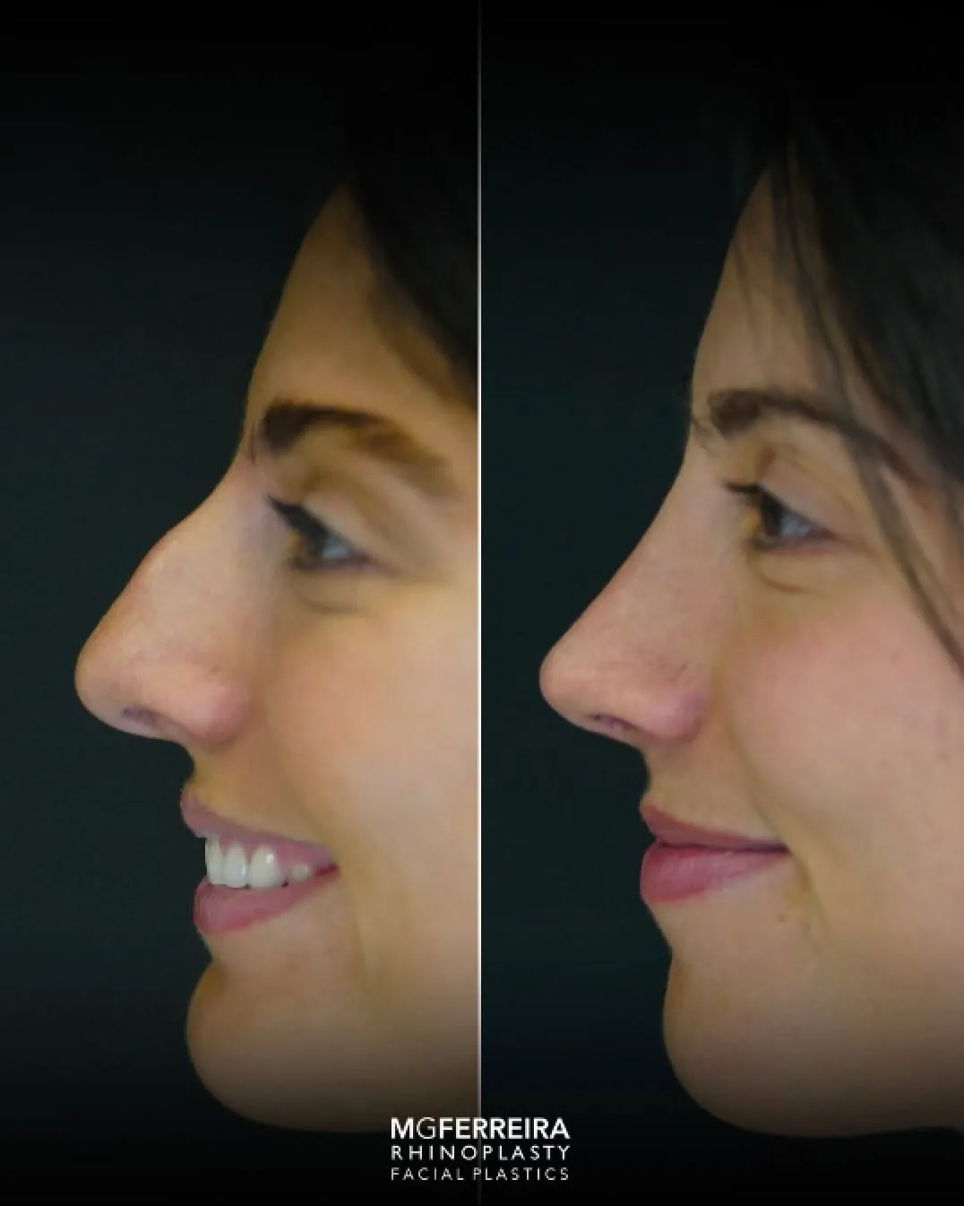 Rinoplastia pós-traumática: desvio nasal complexo, perfil