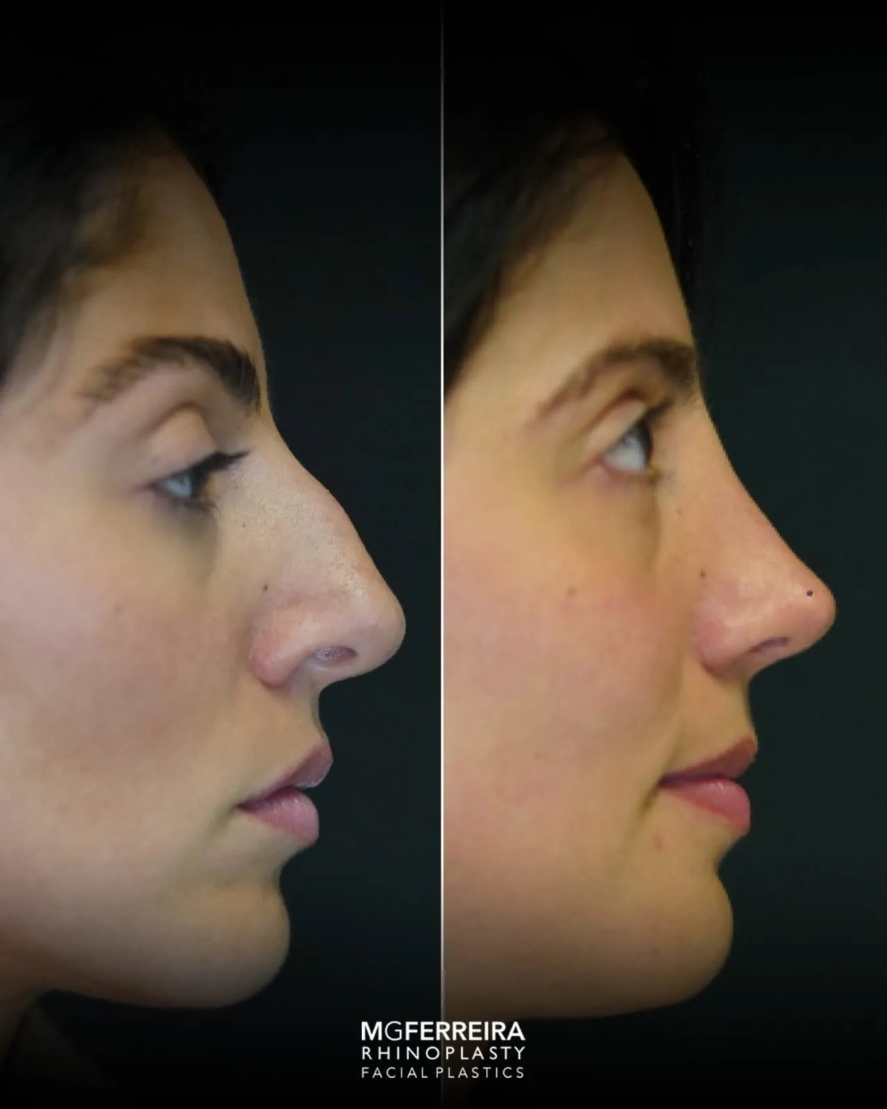 Rinoplastia pós-traumática: desvio nasal complexo, perfil oposto