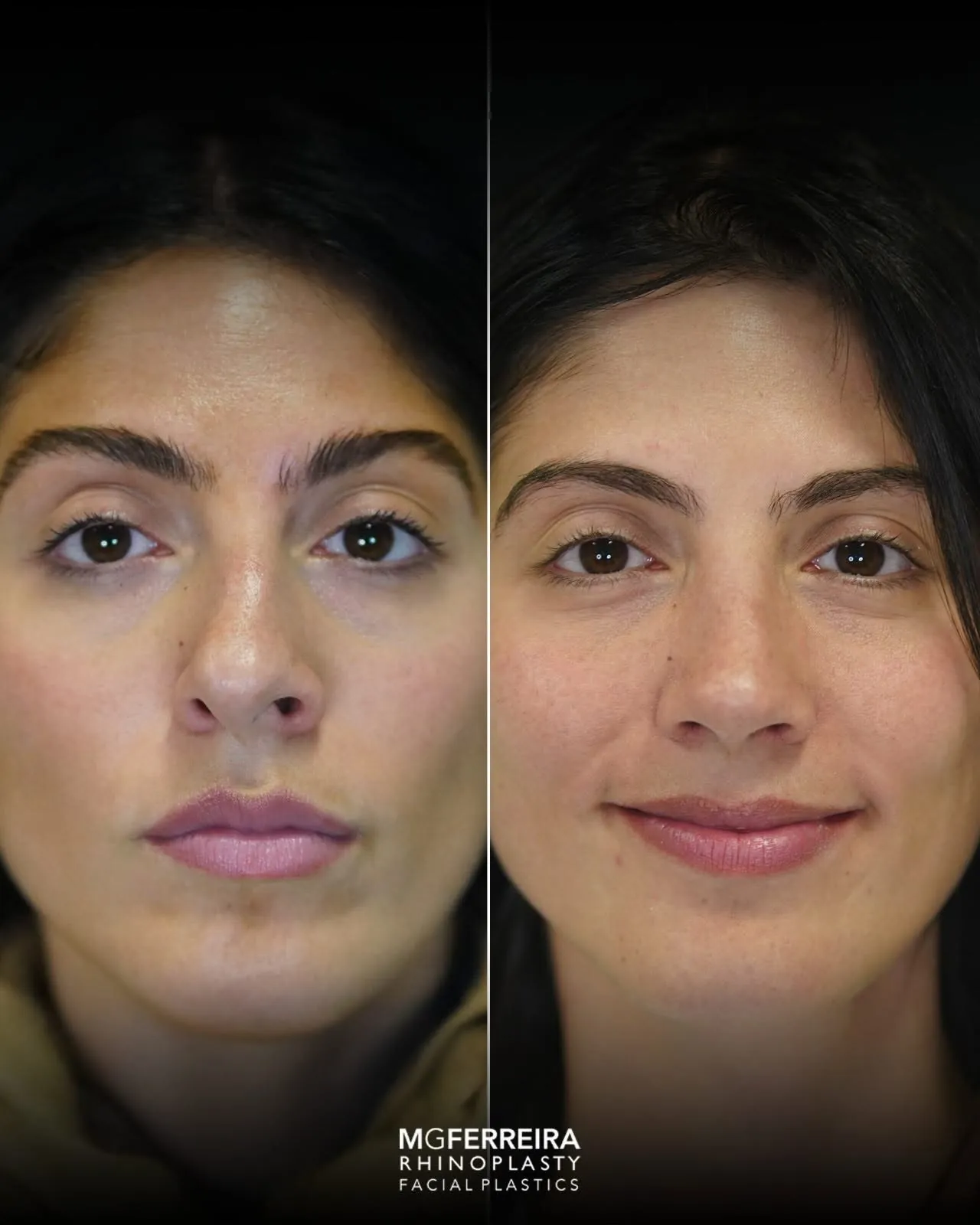 Rinoplastia pós-traumática: desvio nasal complexo, vista frontal