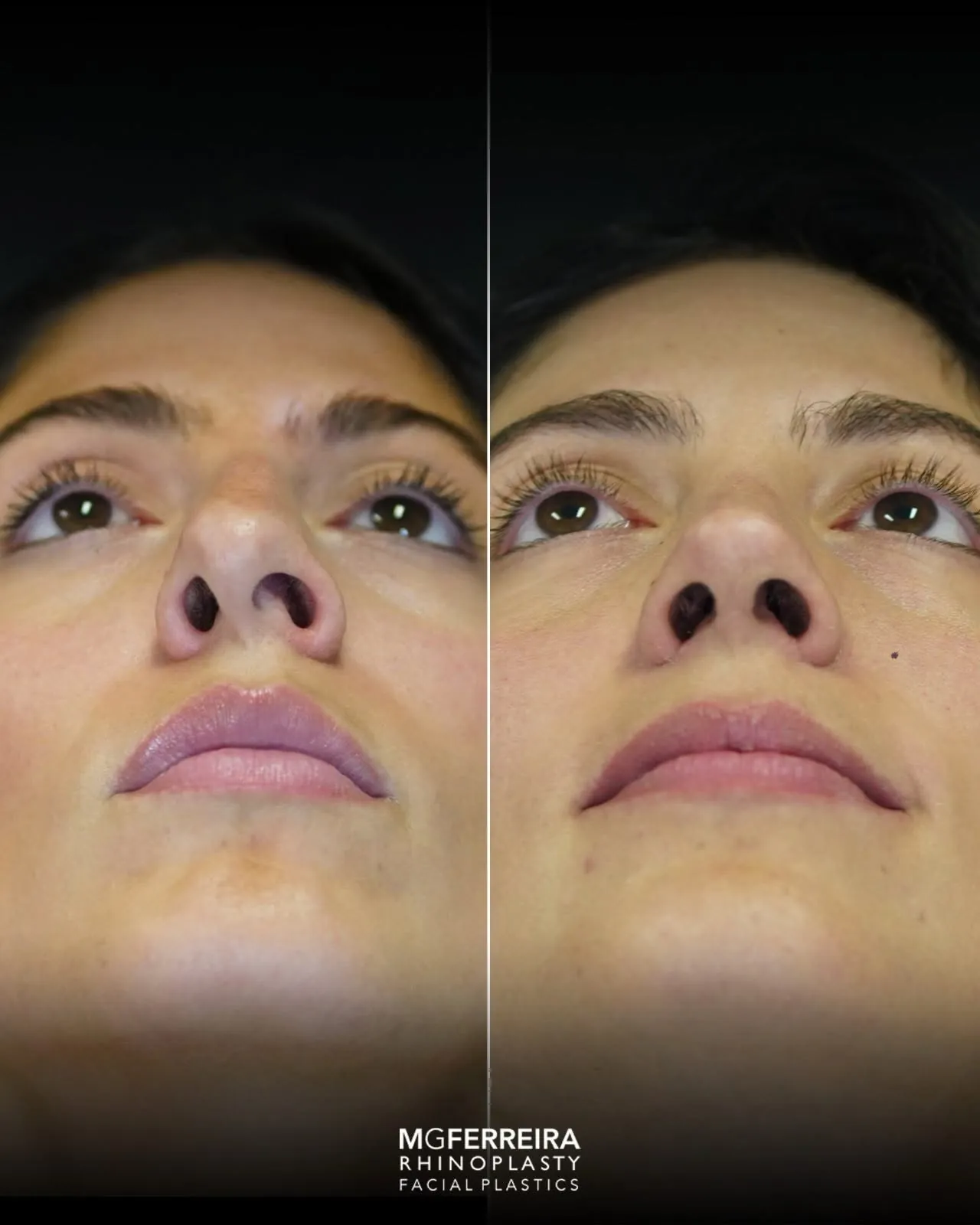 Rinoplastia pós-traumática: desvio nasal complexo, vista inferior